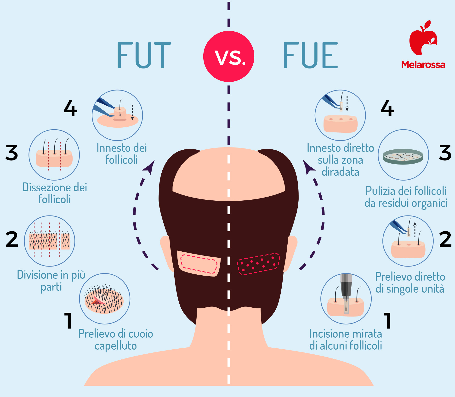 Trapianto capelli: cos'è, costo e come funziona 2 trapianti di capelli: metodi