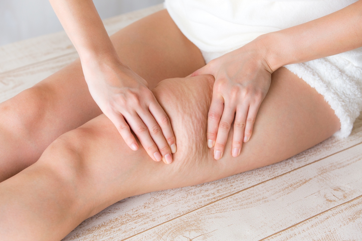 Cellulite: cos'è, quali sono le cause e i rimedi principali 1 che tipo di cellulite hai