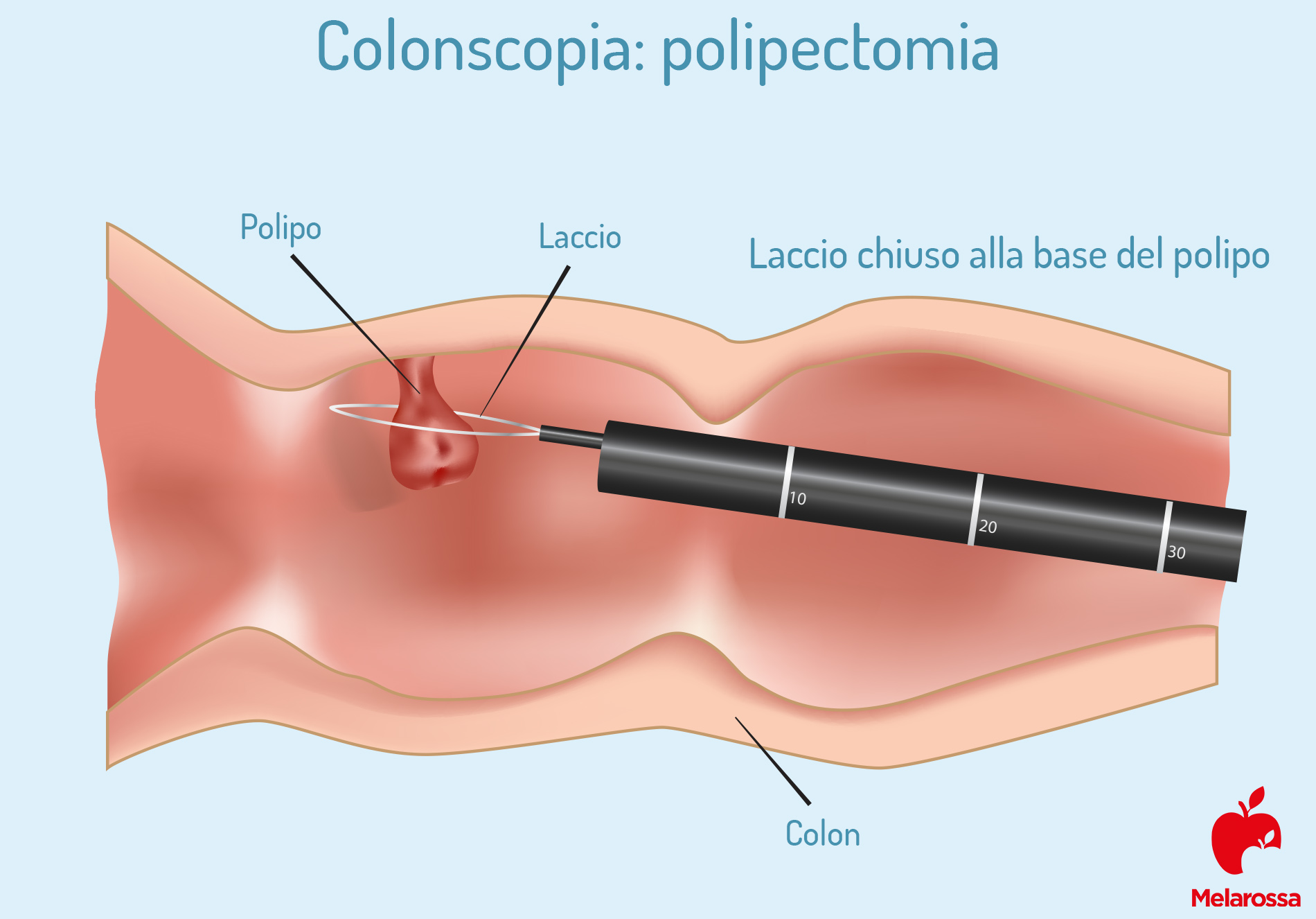 Colonscopia: cos’è, cosa si vede, a cosa serve e quanto è dolorosa 4 colonscopia: polipectomia