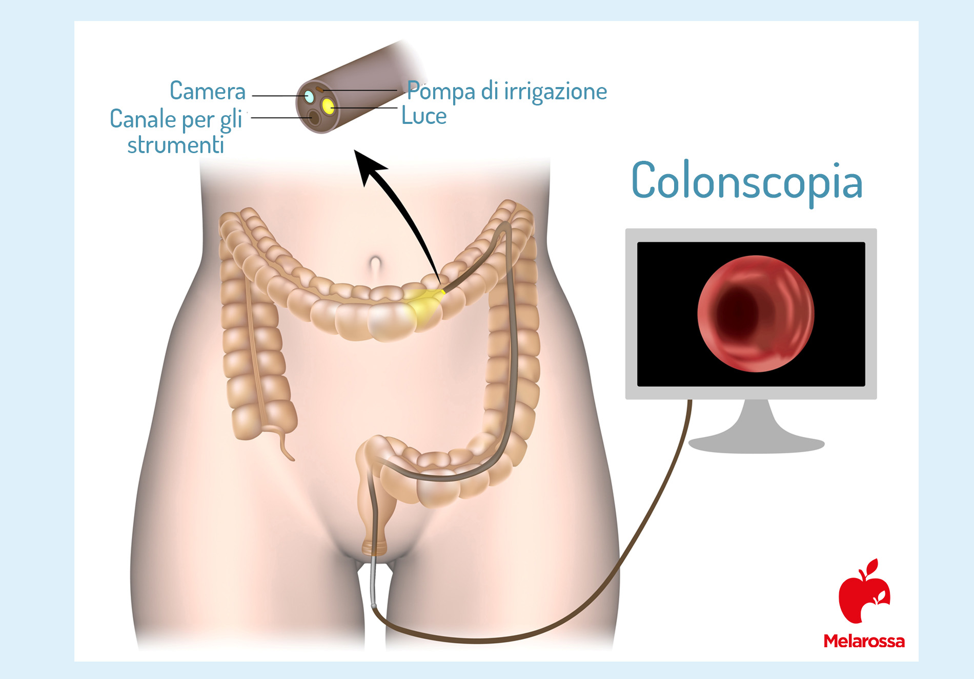 Colonscopia: cos’è, cosa si vede, a cosa serve e quanto è dolorosa 3 colonscopia: come funziona