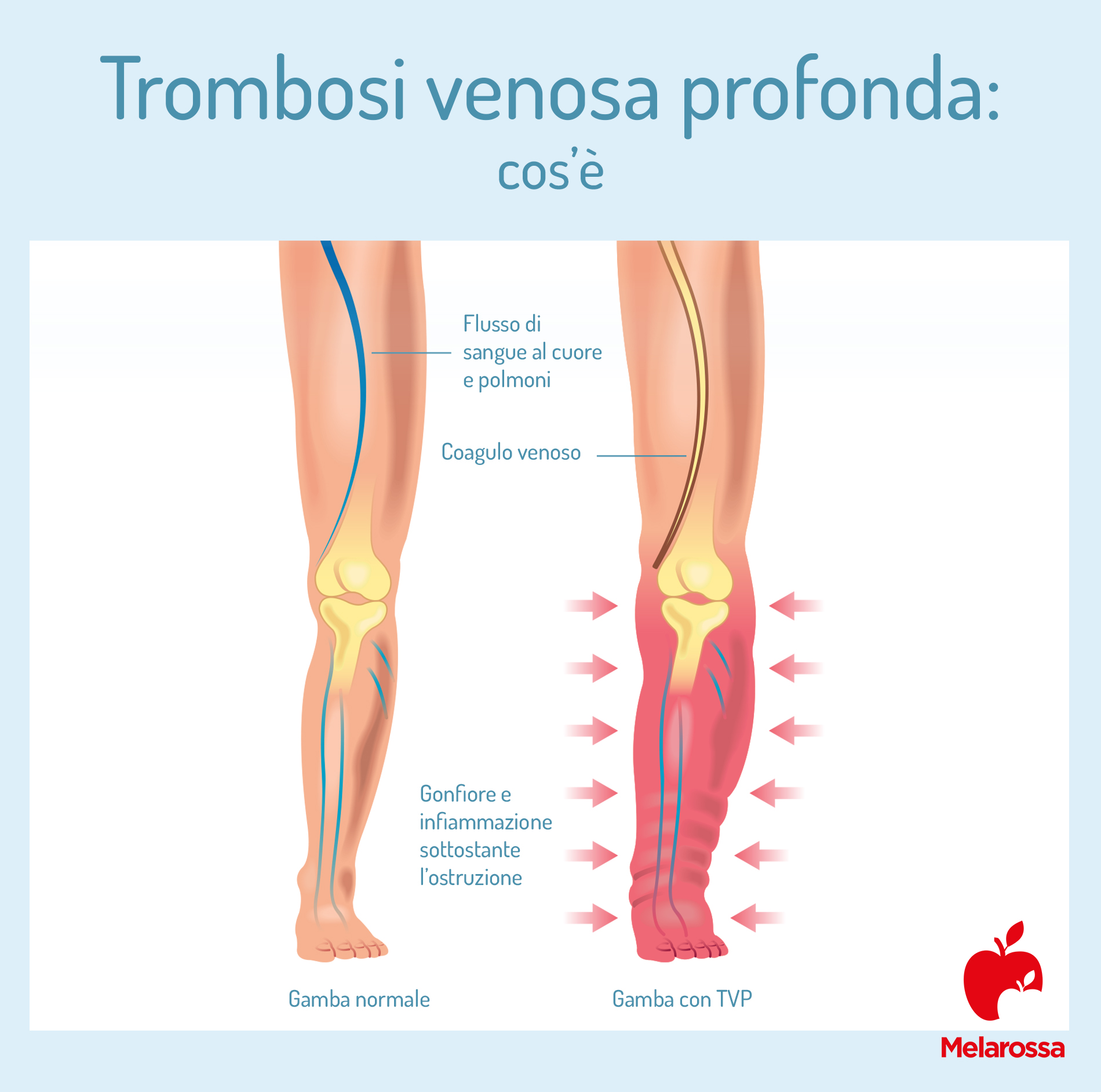 Flebite: cos'è, sintomi, chi rischia di più, prevenzione e come curarla 1 flebite trombosi venosa profonda cos e