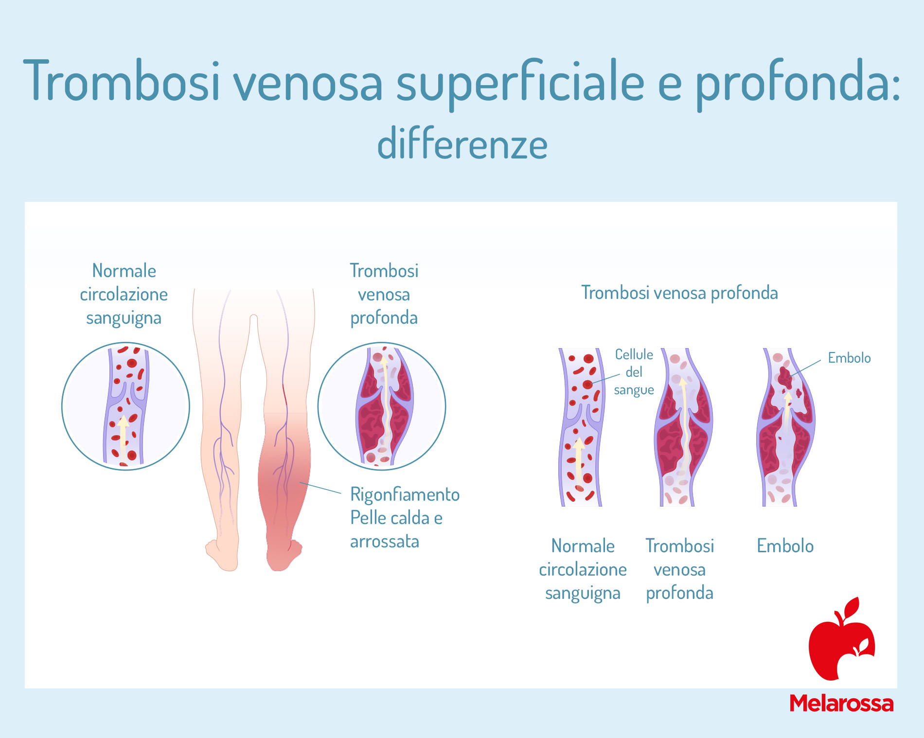Flebite: cos'è, sintomi, chi rischia di più, prevenzione e come curarla 2 Tipi di flebite