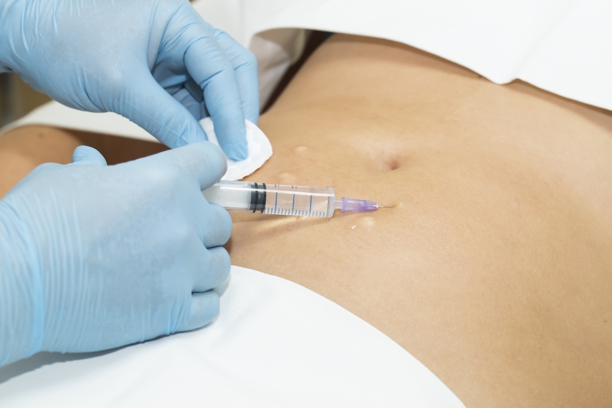 Mesoterapia: cos’è, a cosa serve, benefici, costi, controindicazioni ed effetti collaterali 1 mesoterapia: cos'è