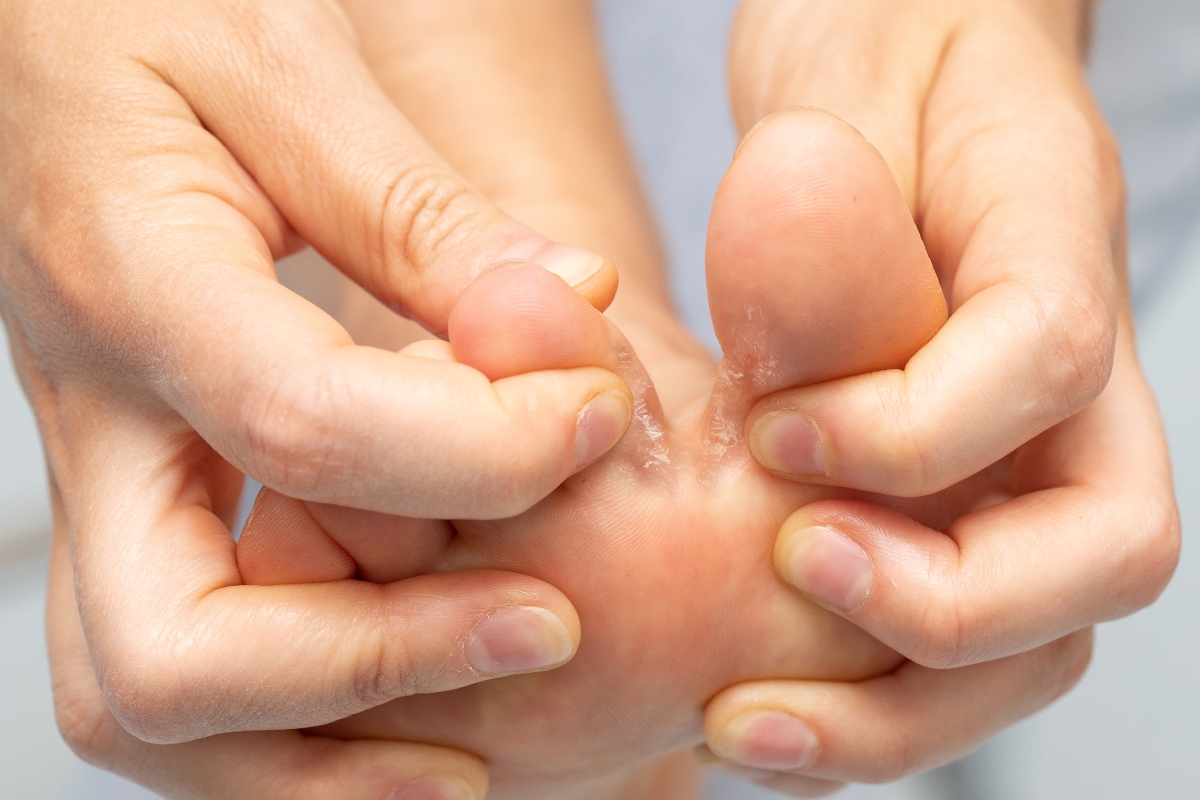 Ragadi: cosa sono, cause, tipologie, sintomi e possibili complicanze, diagnosi, trattamenti e rimedi 5 ragadi ai piedi