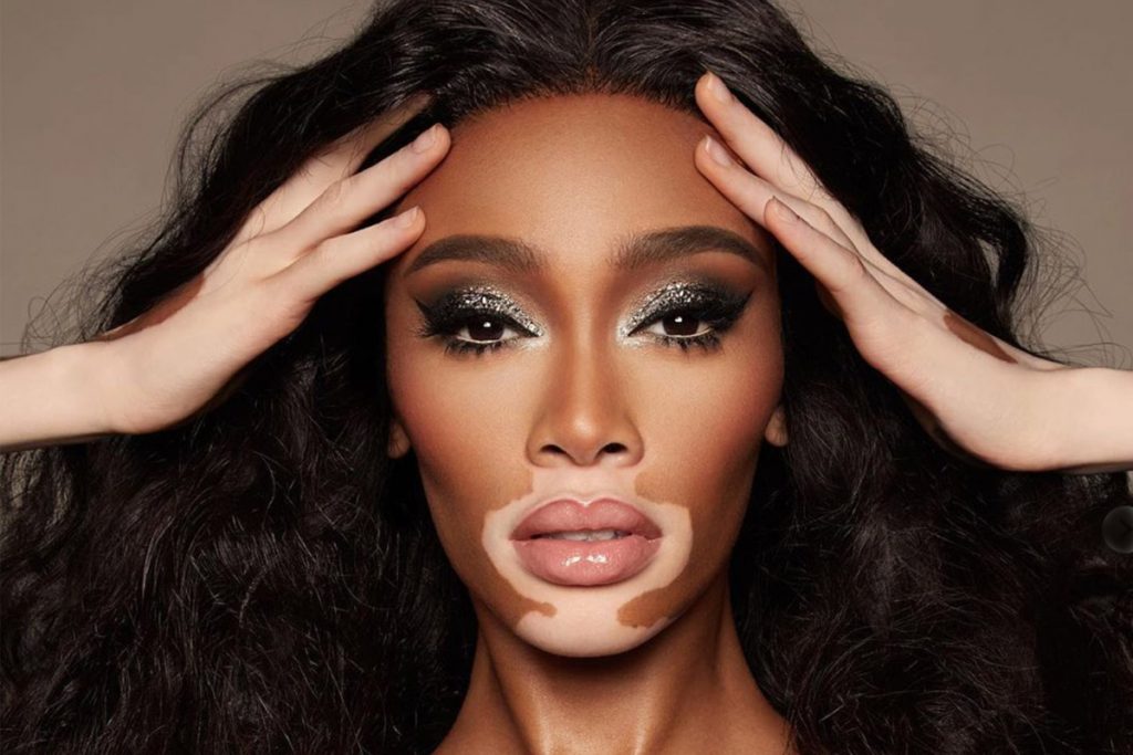 Giornata mondiale della vitiligine: la determinazione di Kasia Smutniak nell’affrontare la malattia 1 vitiligine winnie harlow