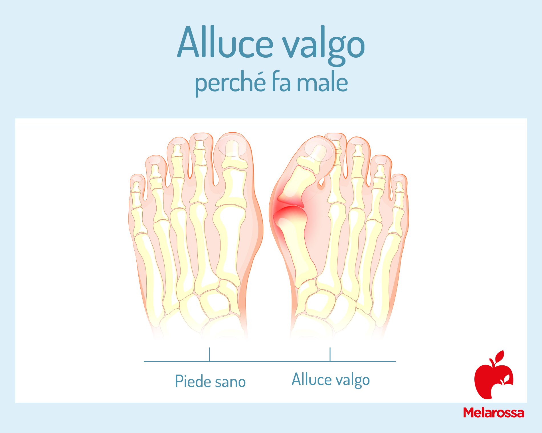 Alluce valgo: cos'è, cause, sintomi, prevenzione e cure 2 Alluce valgo: perché fa male