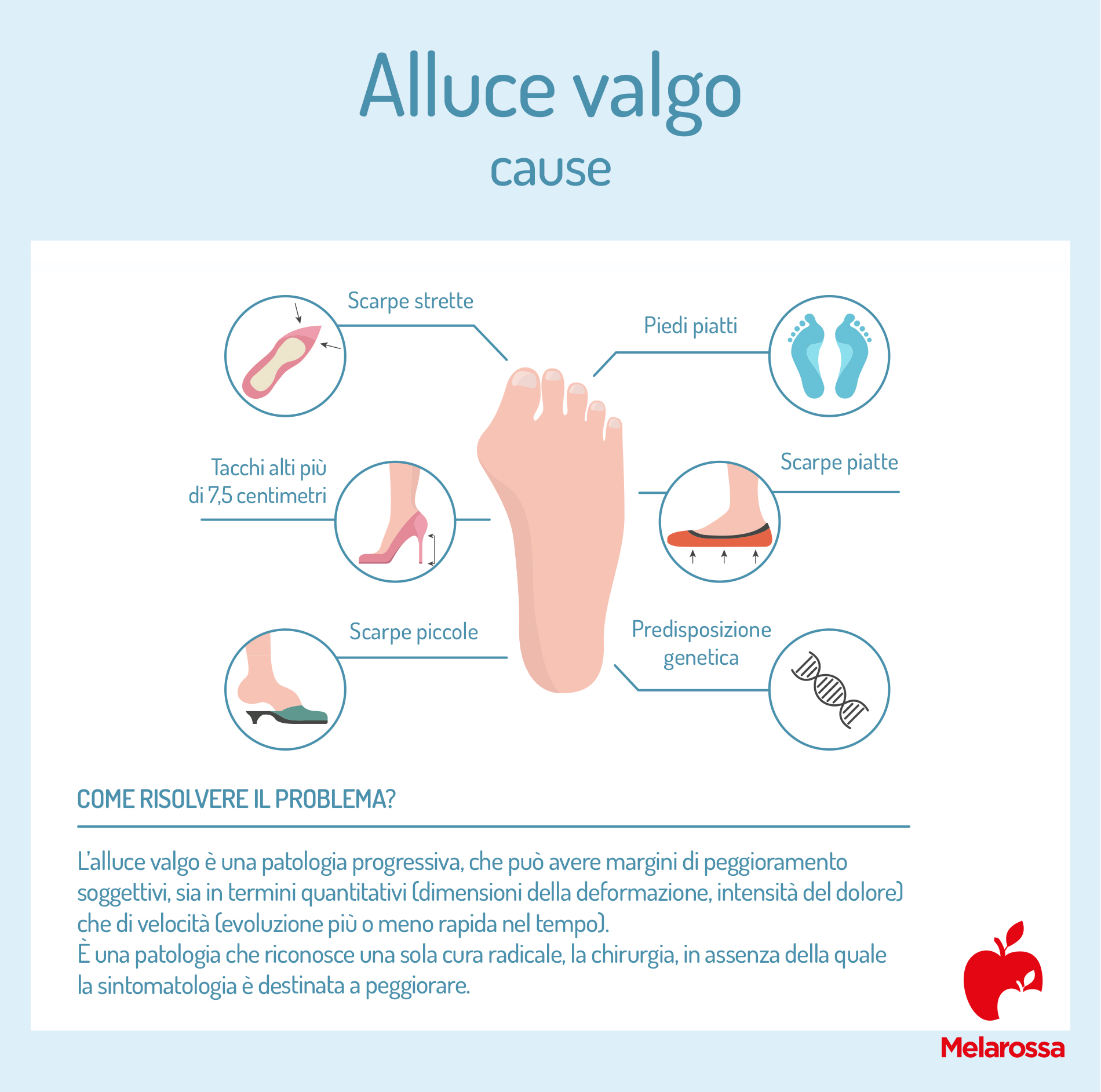 Alluce valgo: cos'è, cause, sintomi, prevenzione e cure 5 Cause dell'alluce valgo