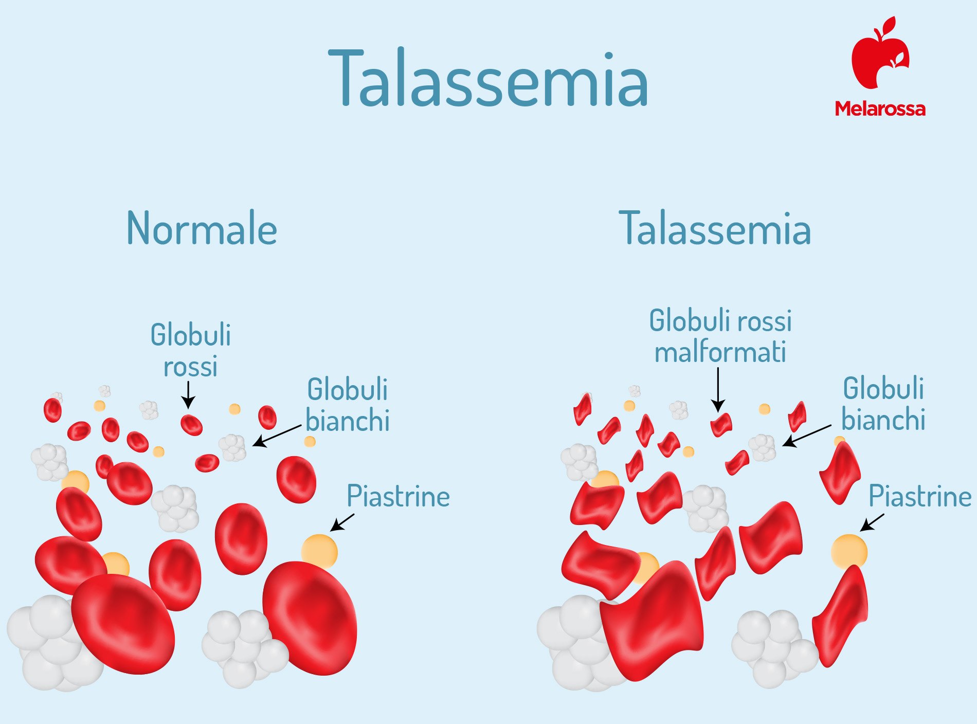 Anemia mediterranea: cos’è, cause, sintomi, classificazione, diagnosi, cure e cosa mangiare 1 anemia mediterranea: globuli rossi