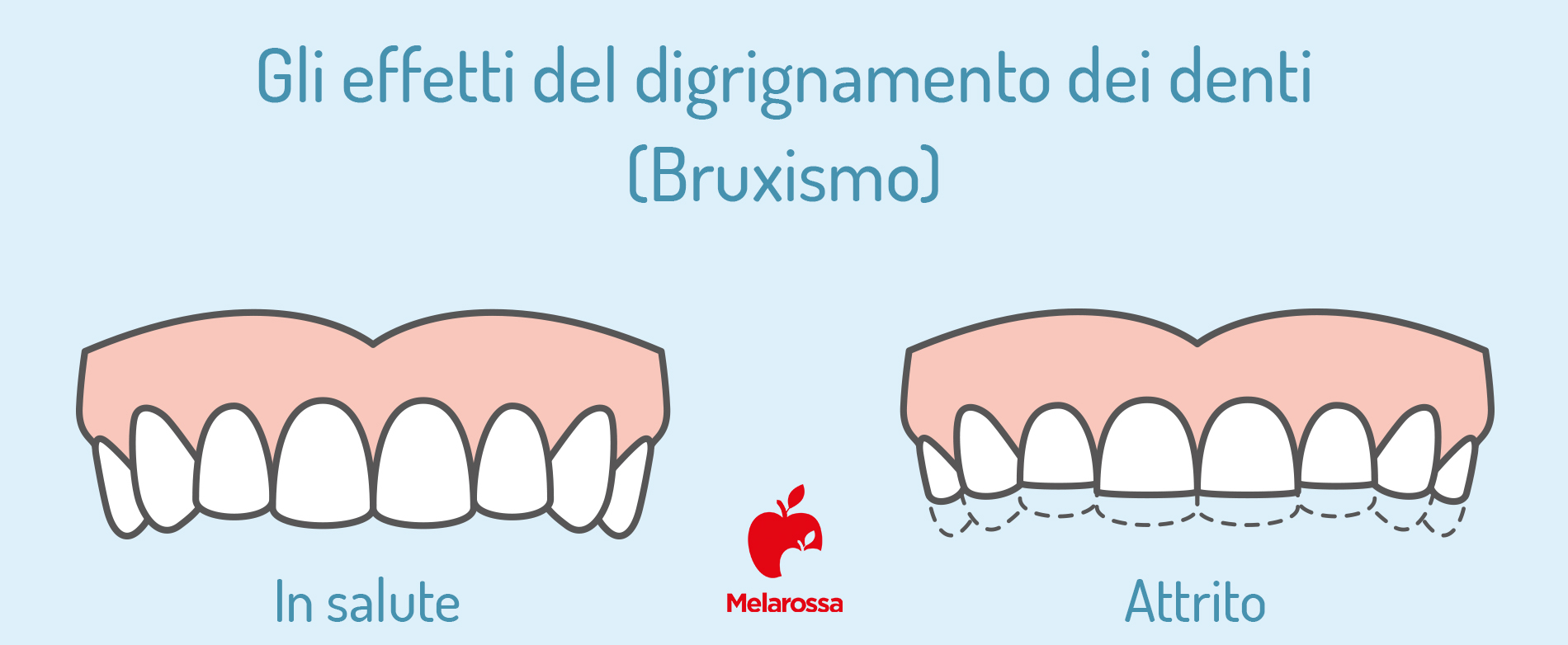Bruxismo: cos’è, cause, sintomi, che tipo di bite scegliere, cure e rimedi naturali 4 bruxismo: che cos'è
