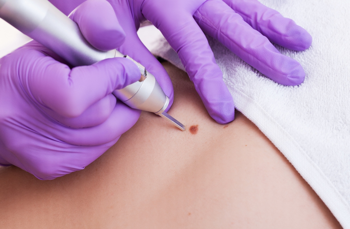 Crioterapia: cos’è, a cosa serve, come funziona, benefici e controindicazioni 6 crioterapia per curare le verruche