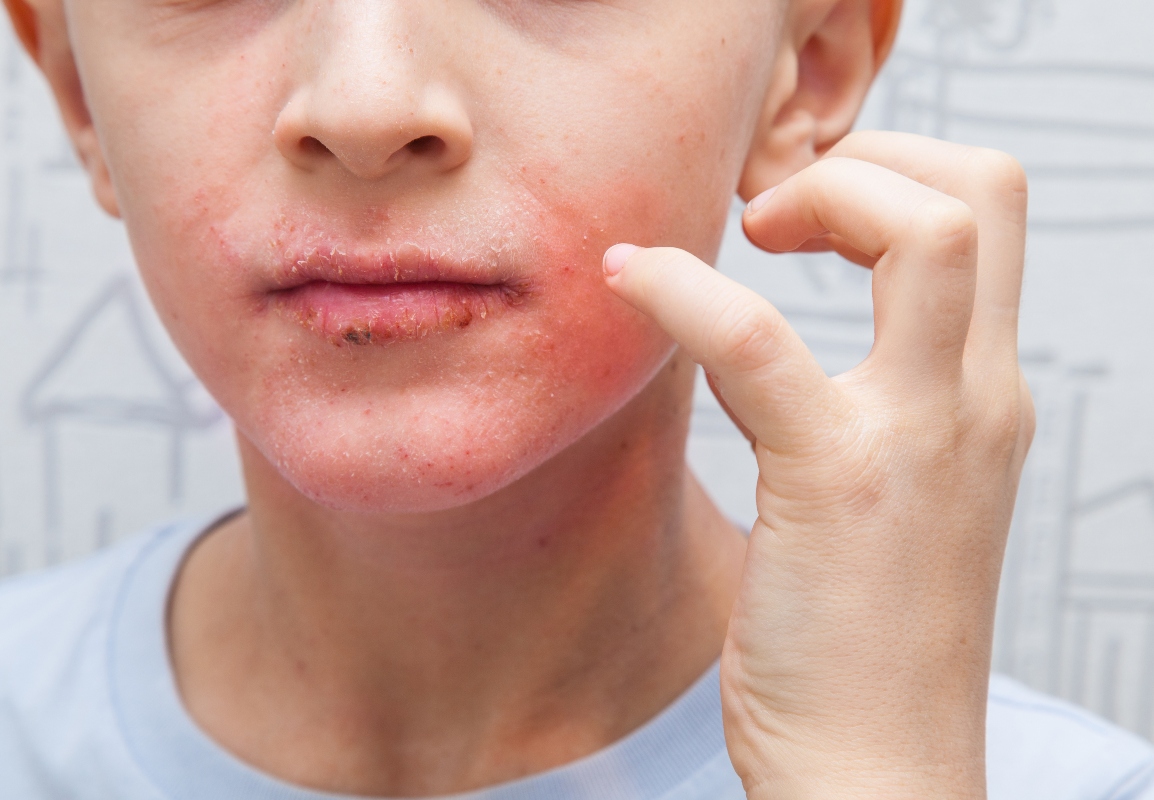 Dermatite: cos’è, tipologie principali, cause, sintomi, cura e trattamento 10 dermatite periorale: foto