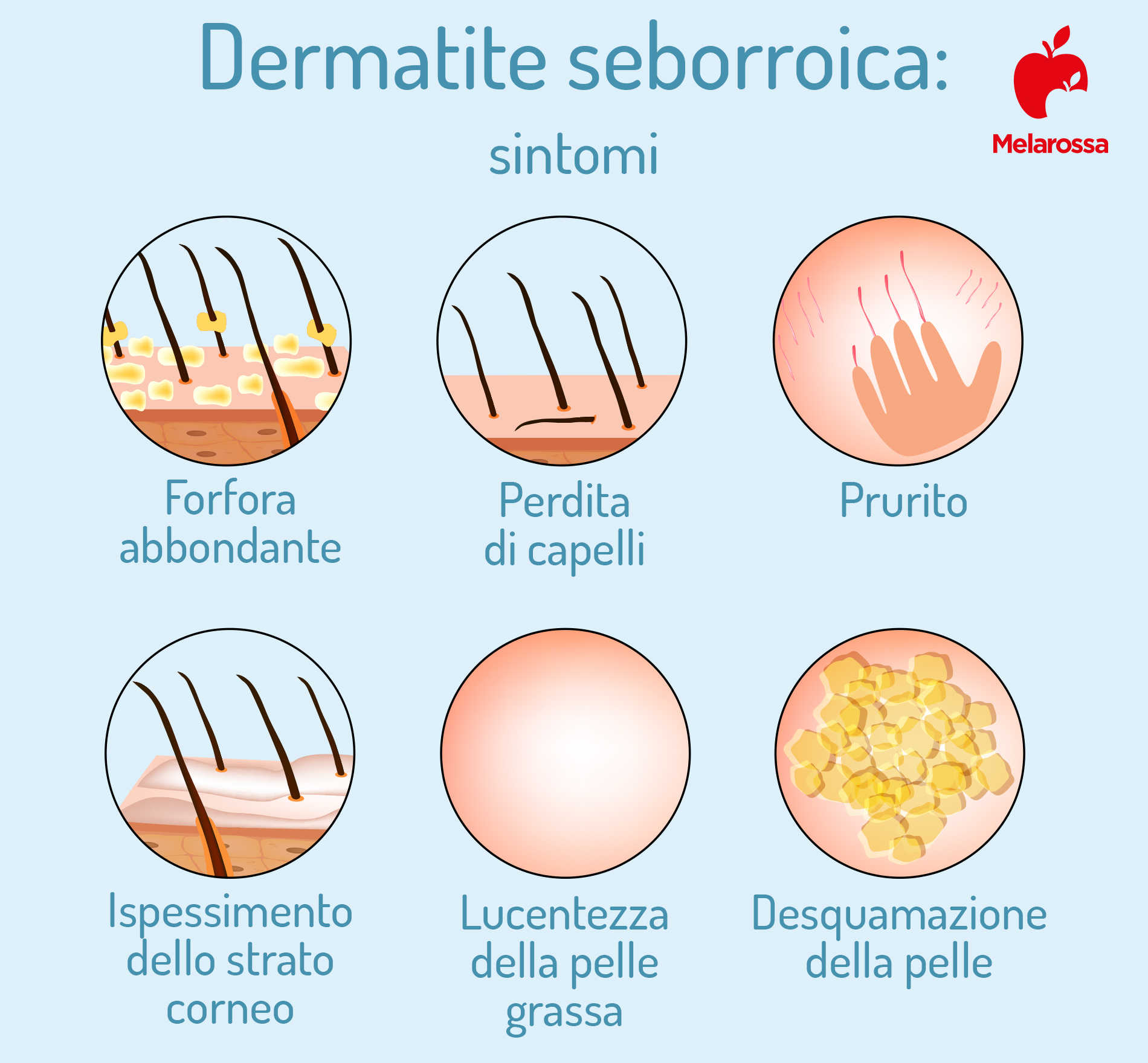 Dermatite: cos’è, tipologie principali, cause, sintomi, cura e trattamento 5 dermatite seborroica: sintomi