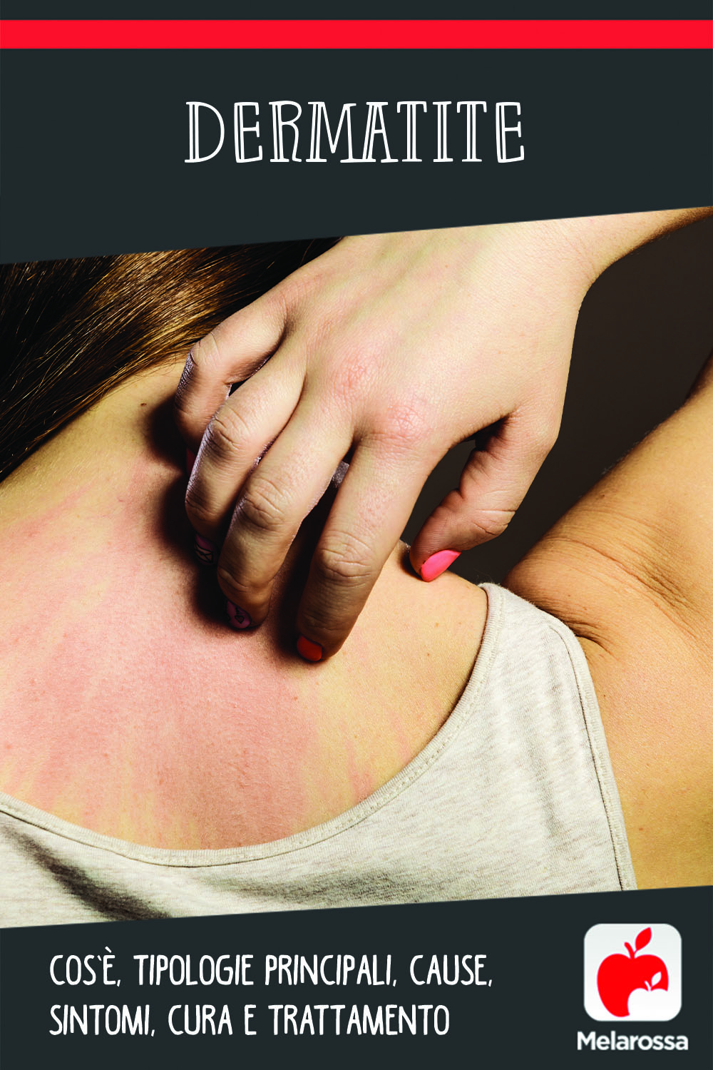Dermatite: cos’è, tipologie principali, cause, sintomi, cura e trattamento 11 dermatite: cos'è, tipi, cause, sintomi e cure