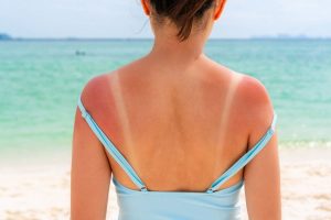 Eritema solare: sintomi, rimedi e creme per proteggere la pelle