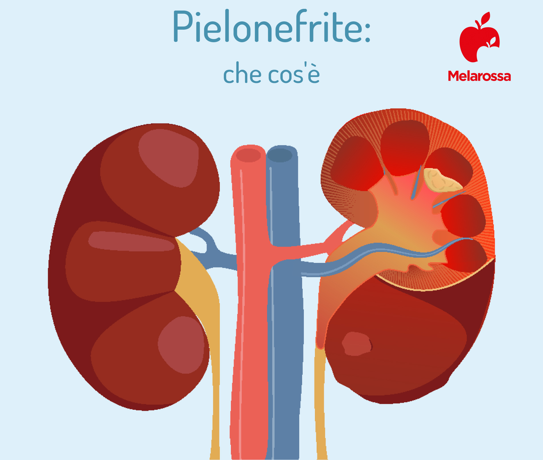 Pielonefrite: cos’è, sintomi, cause, diagnosi, cura e prevenzione 1 pielonefrite: che cos'è