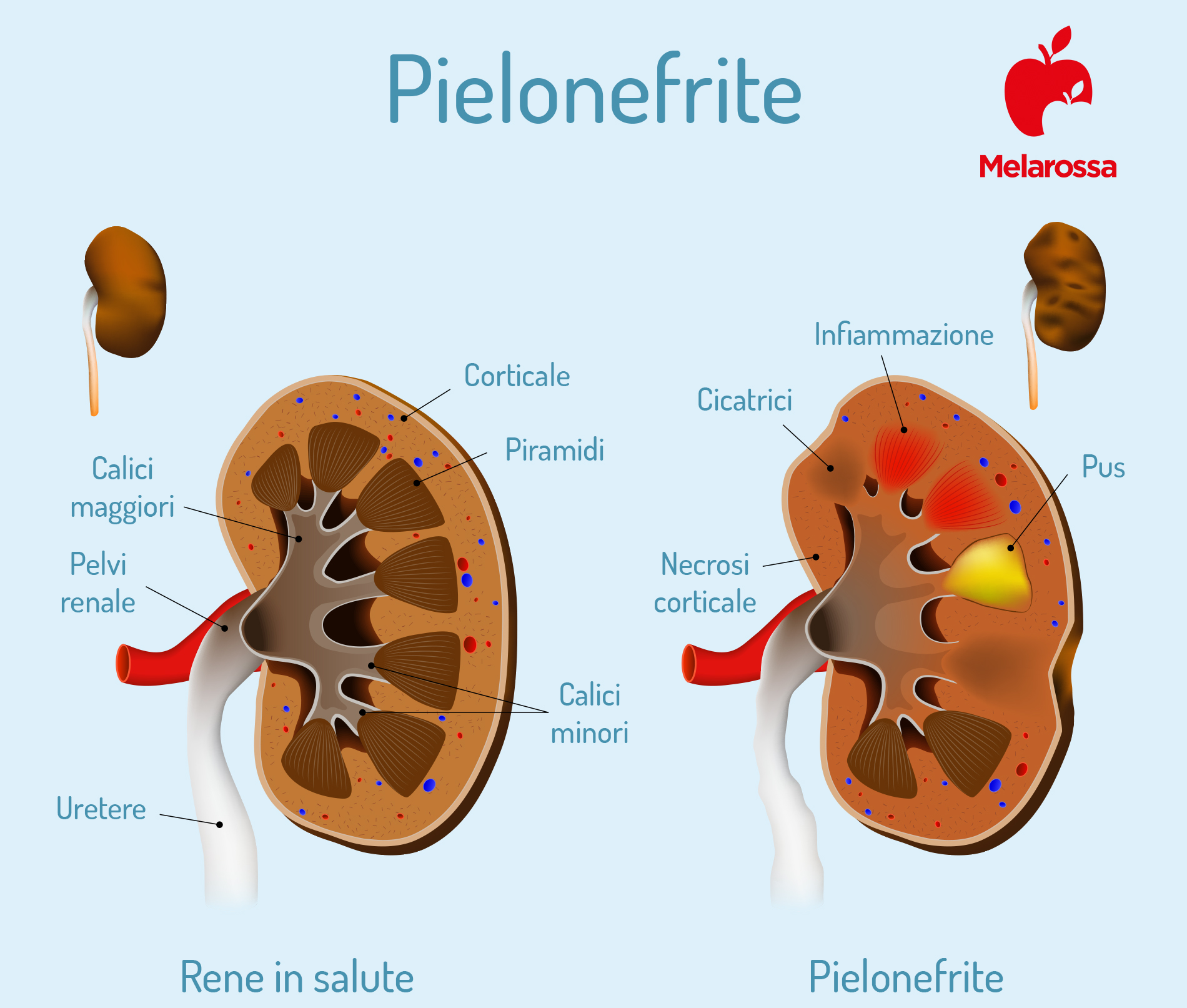 Pielonefrite: cos’è, sintomi, cause, diagnosi, cura e prevenzione 5 Pielonefrite: infiammazione del rene