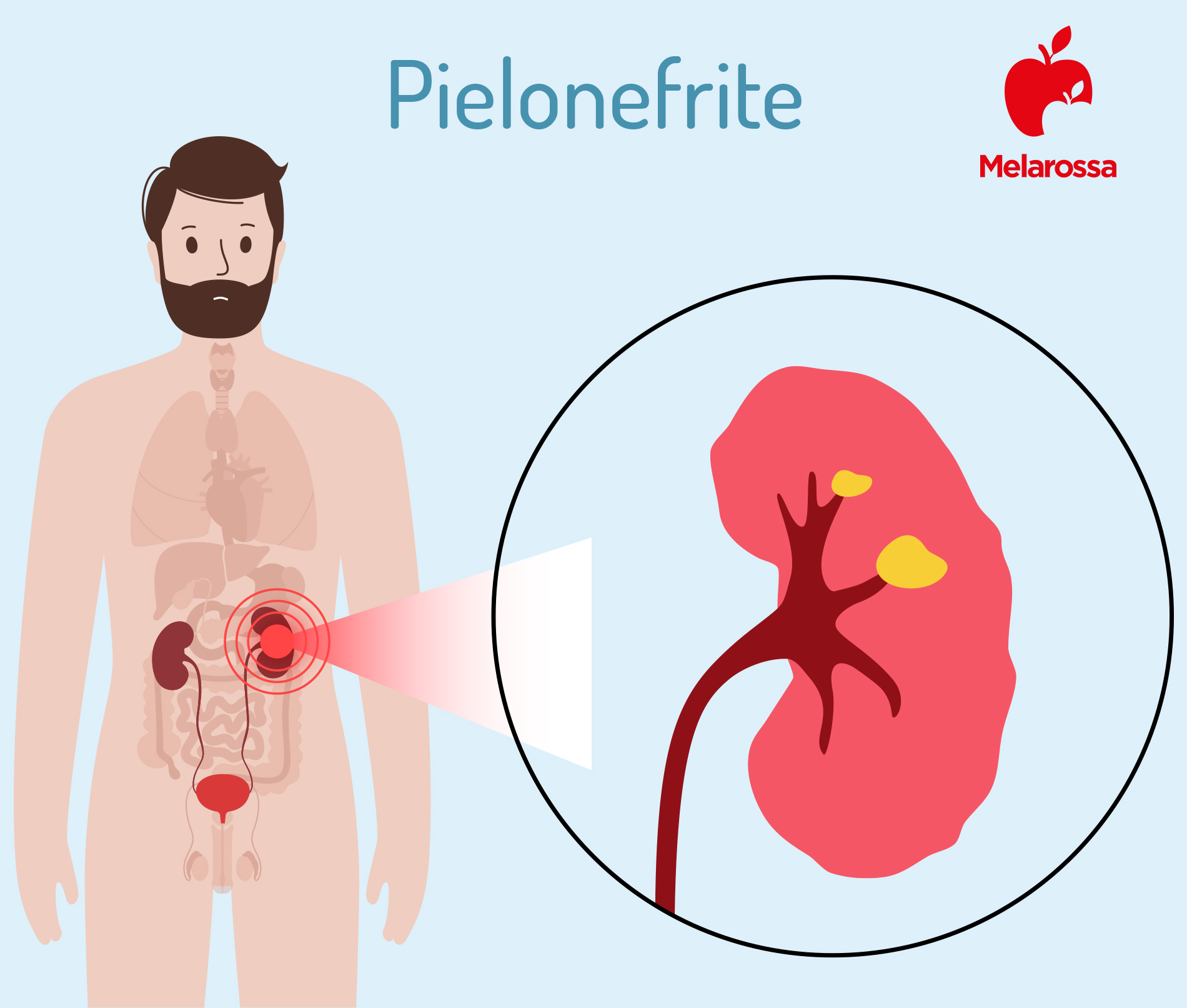 Pielonefrite: cos’è, sintomi, cause, diagnosi, cura e prevenzione 3 quali sono i sintomi della pielonefrite