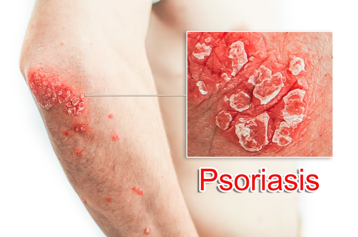 Dermatite: cos’è, tipologie principali, cause, sintomi, cura e trattamento 4 tipi di dermatiti: psoriasi
