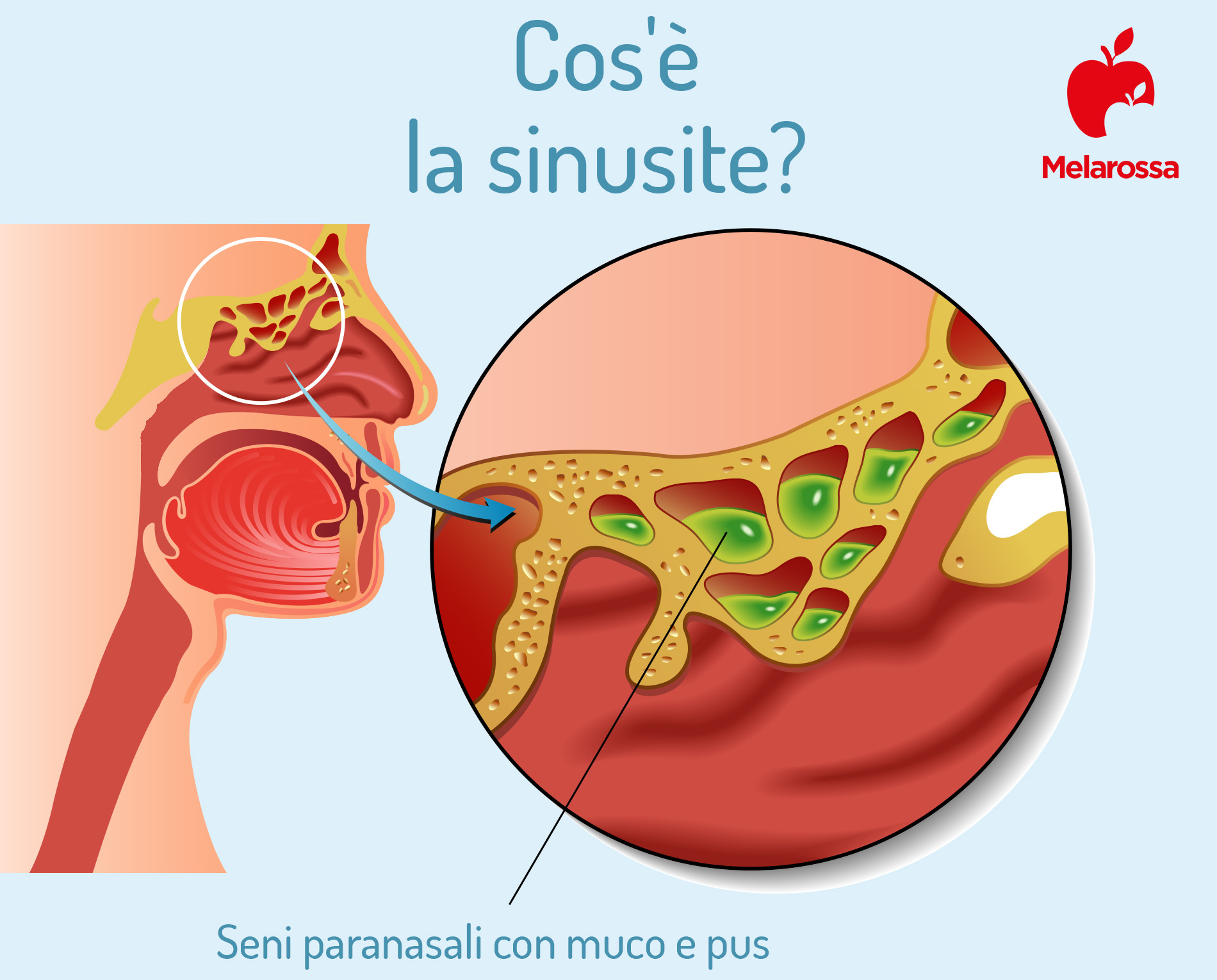 Sinusite: cos'è, sintomi, rimedi, cura e prevenzione 1 sinusite: cos'è