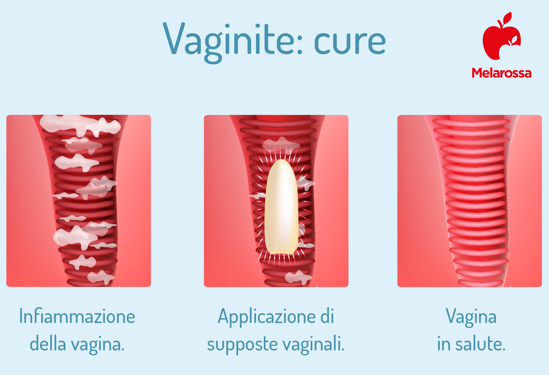 Vaginite: cos’è, tipi, cause, sintomi e trattamenti 7 vaginite: cure