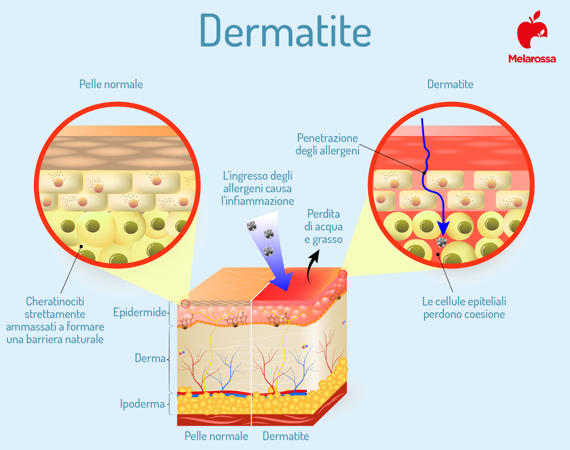 Dermatite: cos’è, tipologie principali, cause, sintomi, cura e trattamento 1 Dermatite