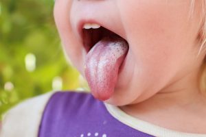 Mughetto: cos&rsquo;&egrave;, cause,  come avviene il contagio, sintomi, cure e prevenzione