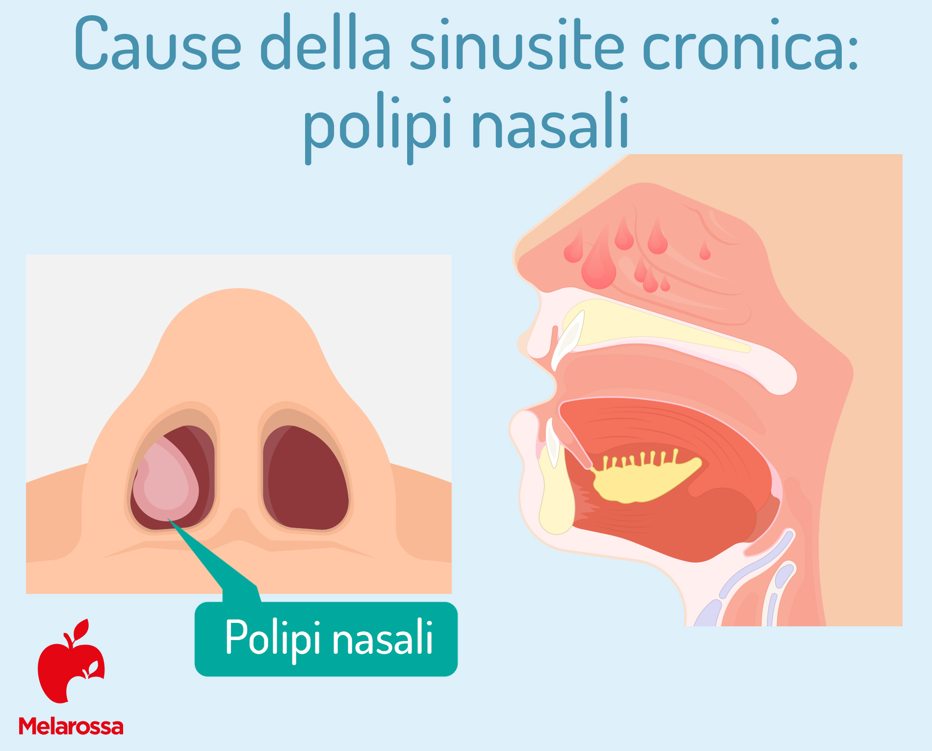 Sinusite: cos'è, sintomi, rimedi, cura e prevenzione 4 Cause della sinusite cronica: polipi nasali