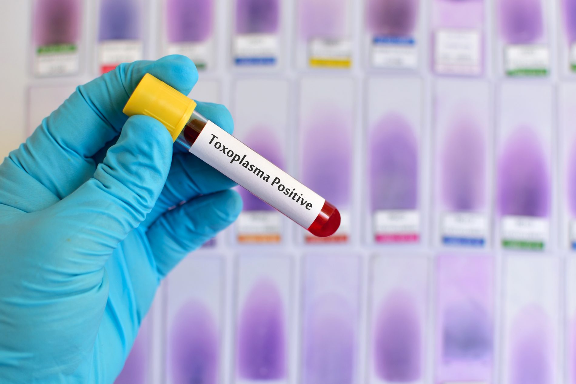Toxoplasmosi: cos’è, gravidanza, sintomi, cure e prevenzione 2 una ano con dei guanti ospedalieri che tiene in mano una provetta per gli esami per la toxoplasmosi