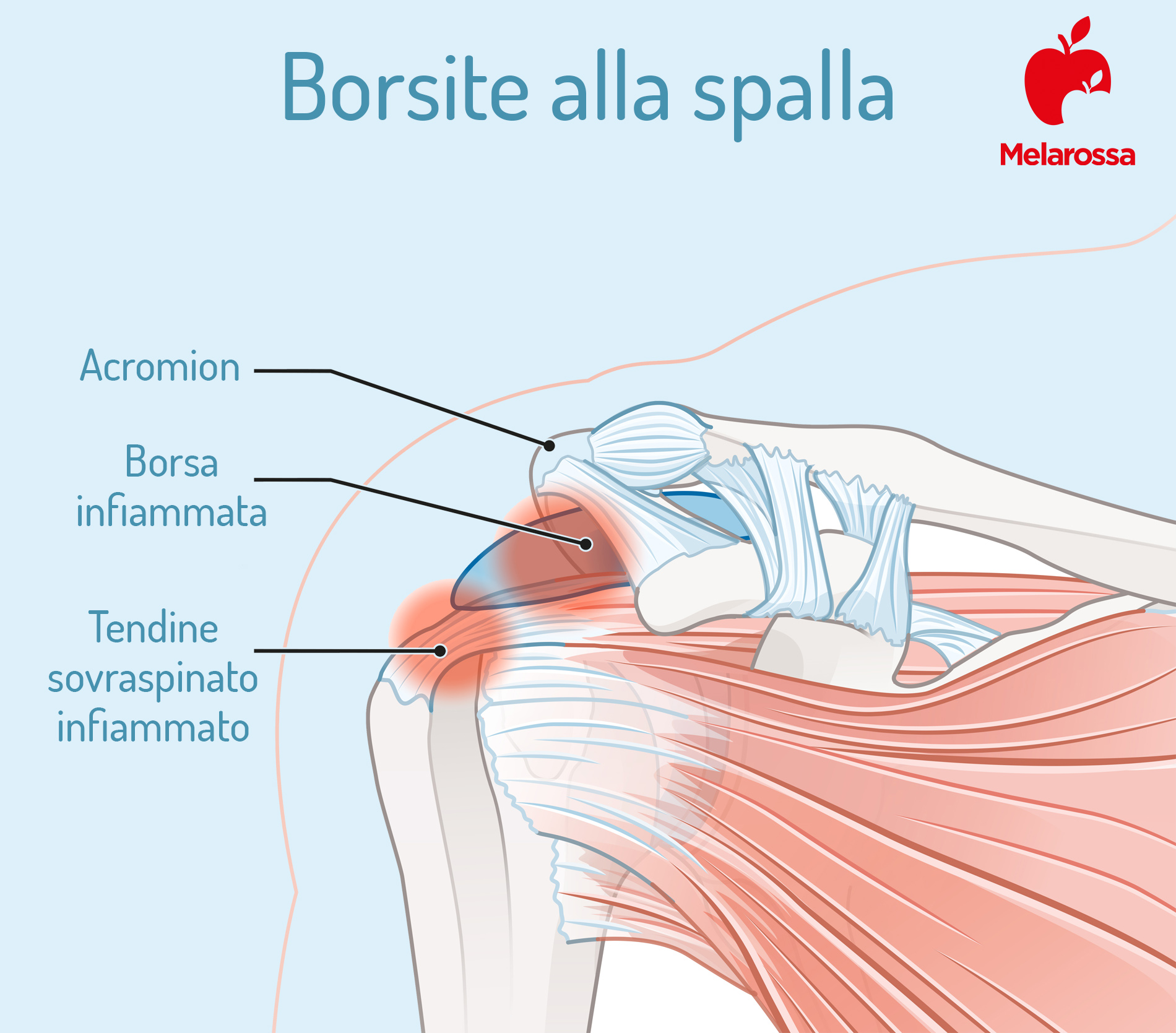 Borsite: che cos’è, tipi, cause e fattori di rischio, sintomi, diagnosi e cure 2 borsite alla spalla: sintomi