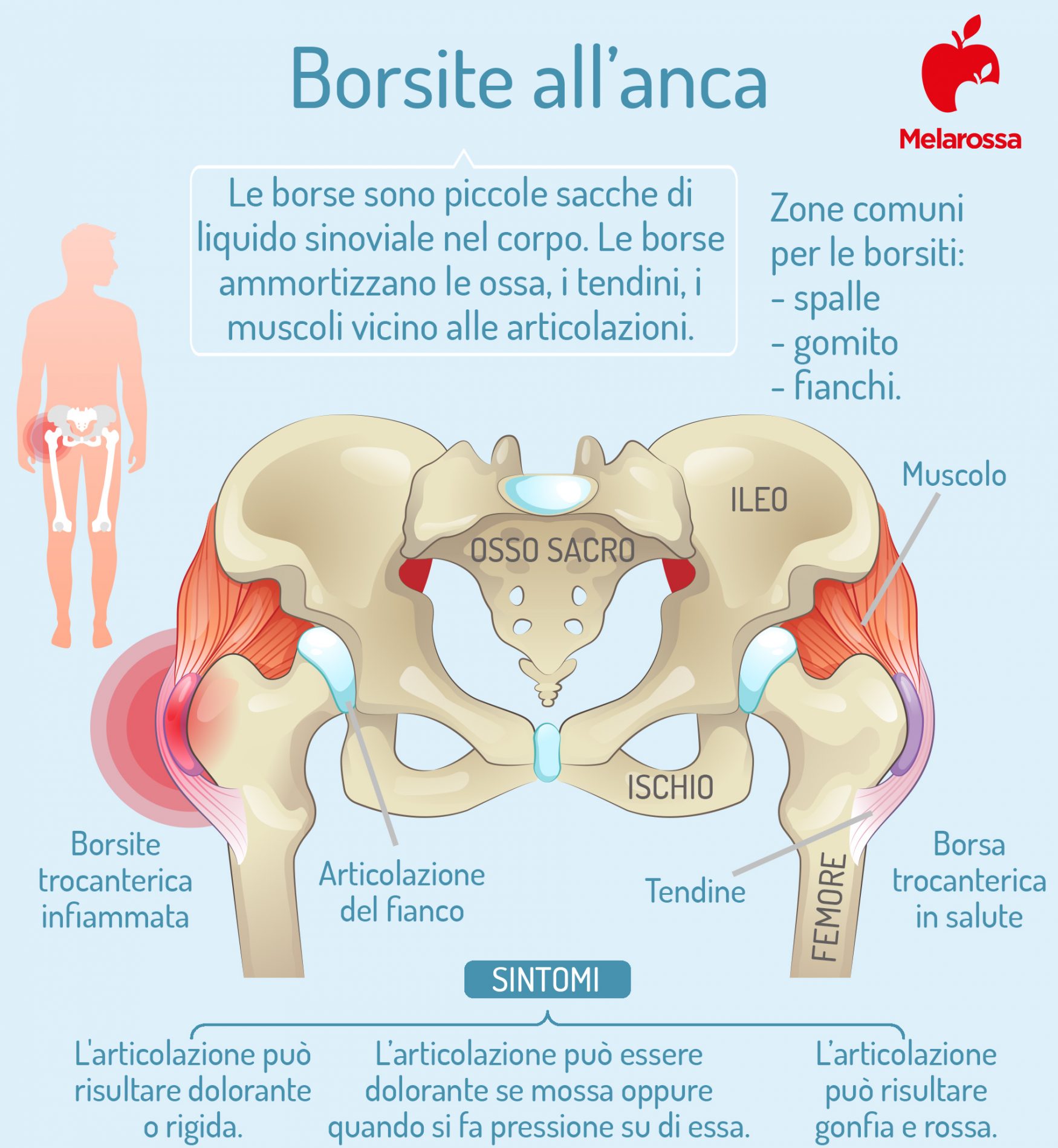 Borsite: che cos’è, tipi, cause e fattori di rischio, sintomi, diagnosi e cure 3 borsite all' anca