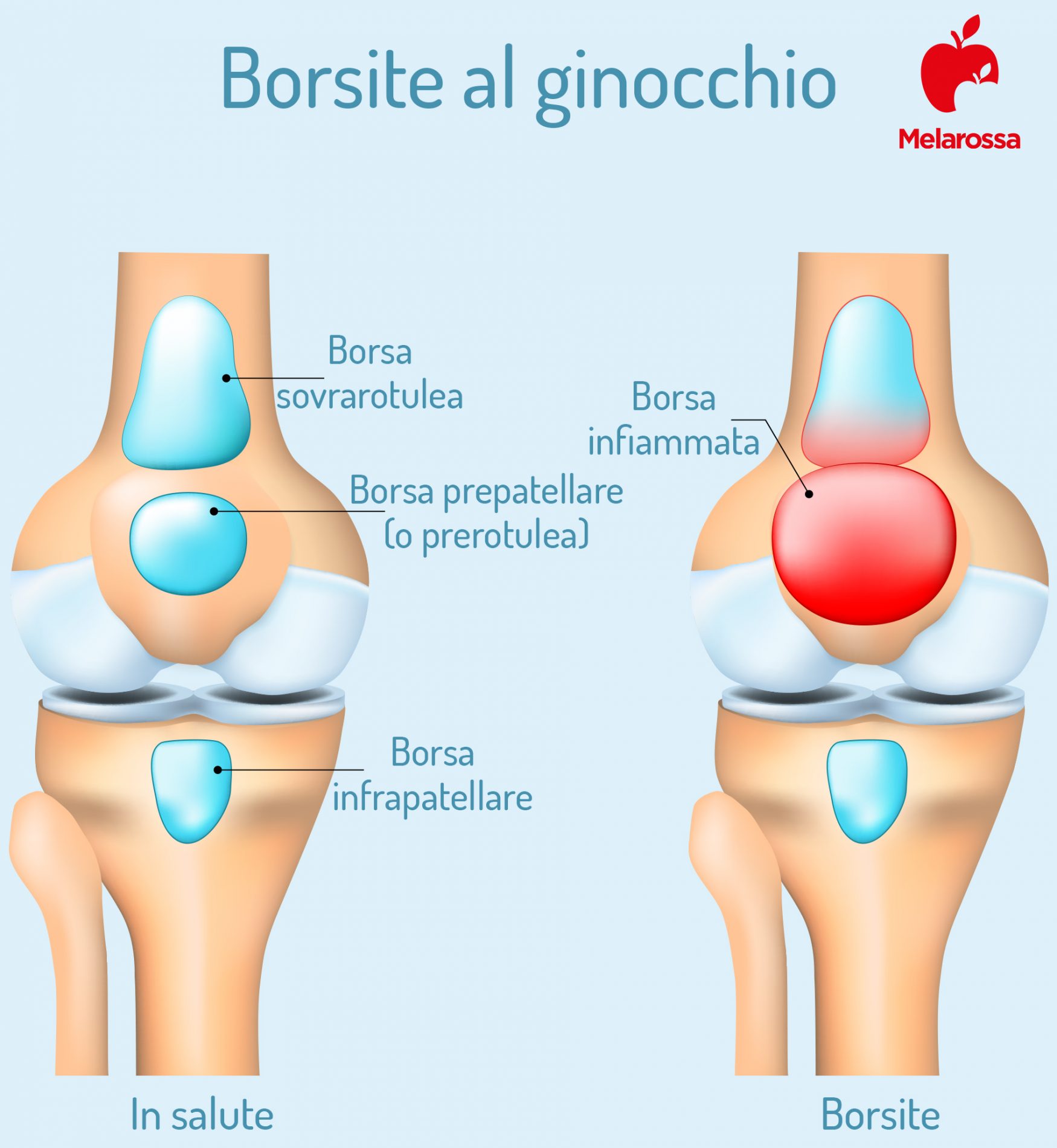 Borsite: che cos’è, tipi, cause e fattori di rischio, sintomi, diagnosi e cure 4 borsite ginocchio