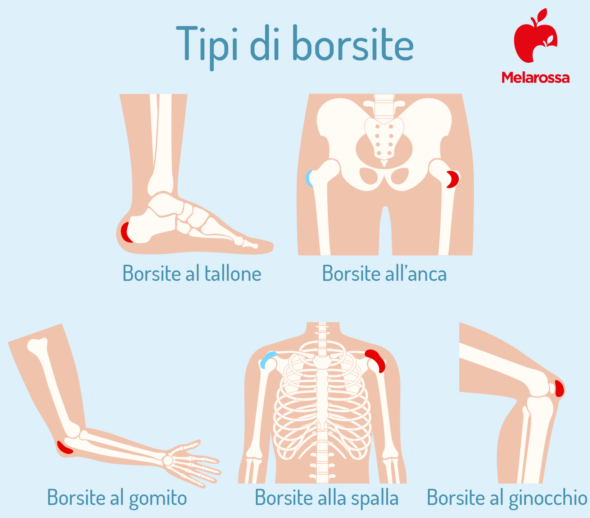 Borsite: che cos’è, tipi, cause e fattori di rischio, sintomi, diagnosi e cure 1 tipi di borsite