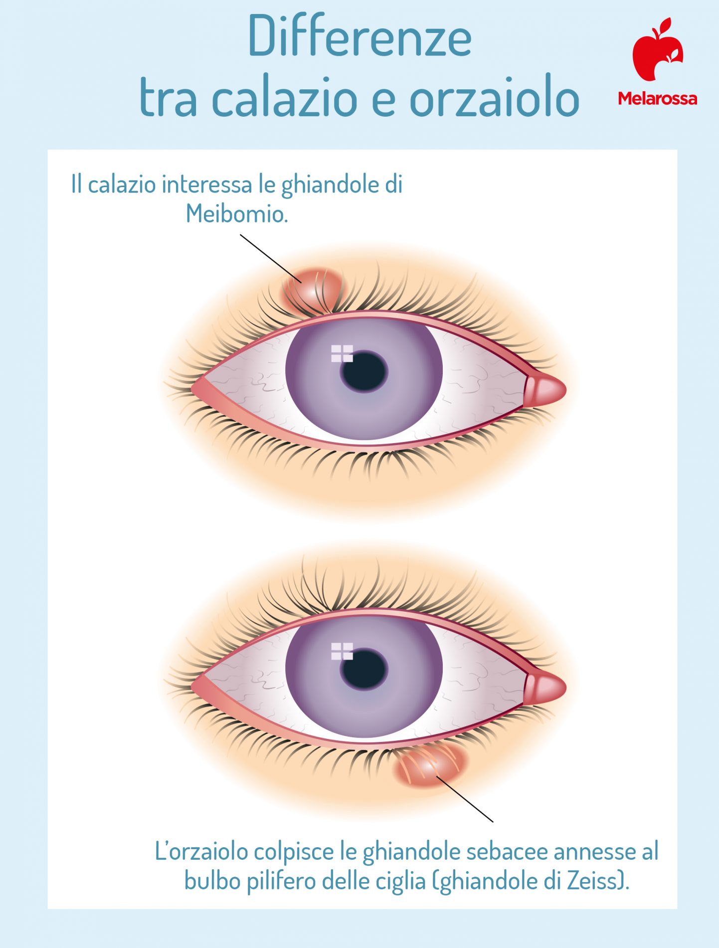 Calazio: cos’è, cause, sintomi, fattori di rischio, come si cura, rimedi naturali 2 differenze tra calazio e orzaiolo