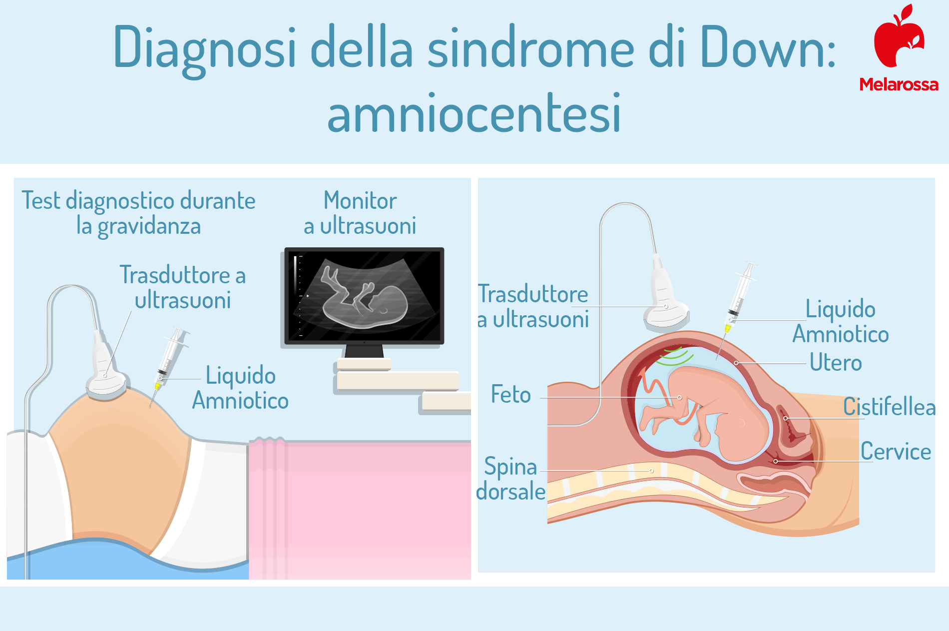 Sindrome di Down: cos’è la trisomia 21, cause, sintomi, complicanze, diagnosi, qualità e aspettative di vita 6 sindrome di Down: diagnosi