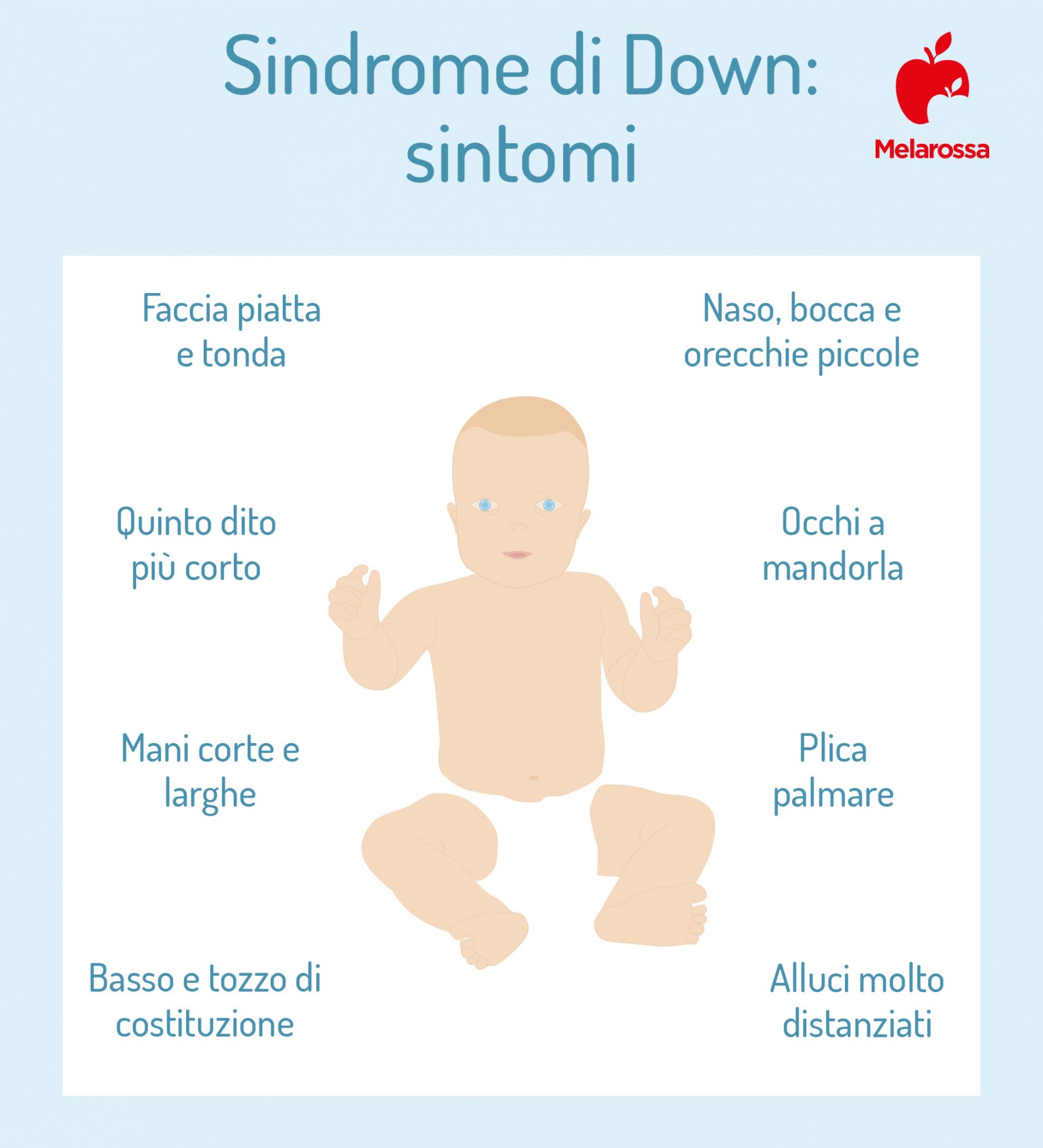 Sindrome di Down: cos’è la trisomia 21, cause, sintomi, complicanze, diagnosi, qualità e aspettative di vita 3 sindrome di Down: sintomi