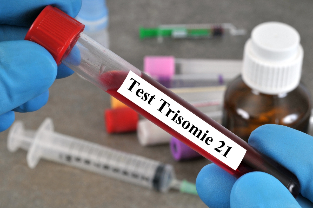 Sindrome di Down: cos’è la trisomia 21, cause, sintomi, complicanze, diagnosi, qualità e aspettative di vita 4 sindrome di Down: test da fare in gravidanza