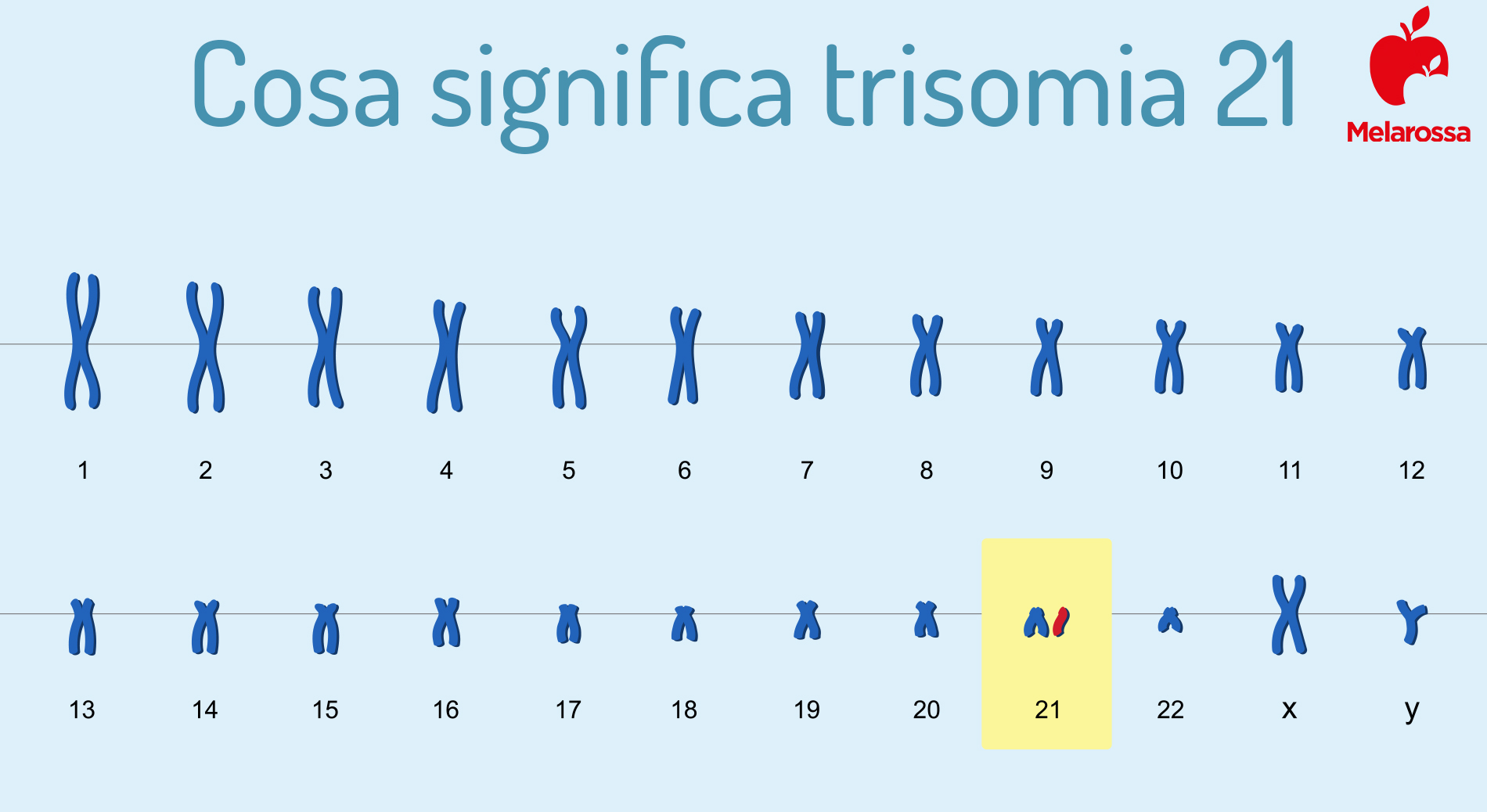 Sindrome di Down: cos’è la trisomia 21, cause, sintomi, complicanze, diagnosi, qualità e aspettative di vita 1 sindrome di Down e trisomia 21