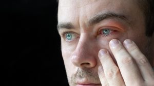 Blefarite: cos&rsquo;&egrave;, tipi, cause, sintomi, diagnosi, cure e trattamento, prevenzione