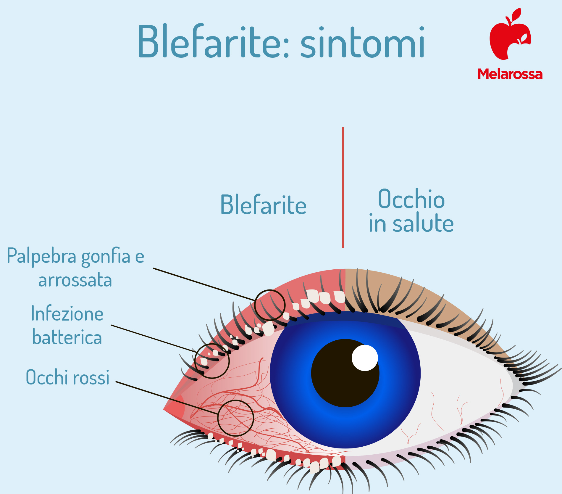 Blefarite: cos’è, tipi, cause, sintomi, diagnosi, cure e trattamento, prevenzione 3 blefarite: sintomi
