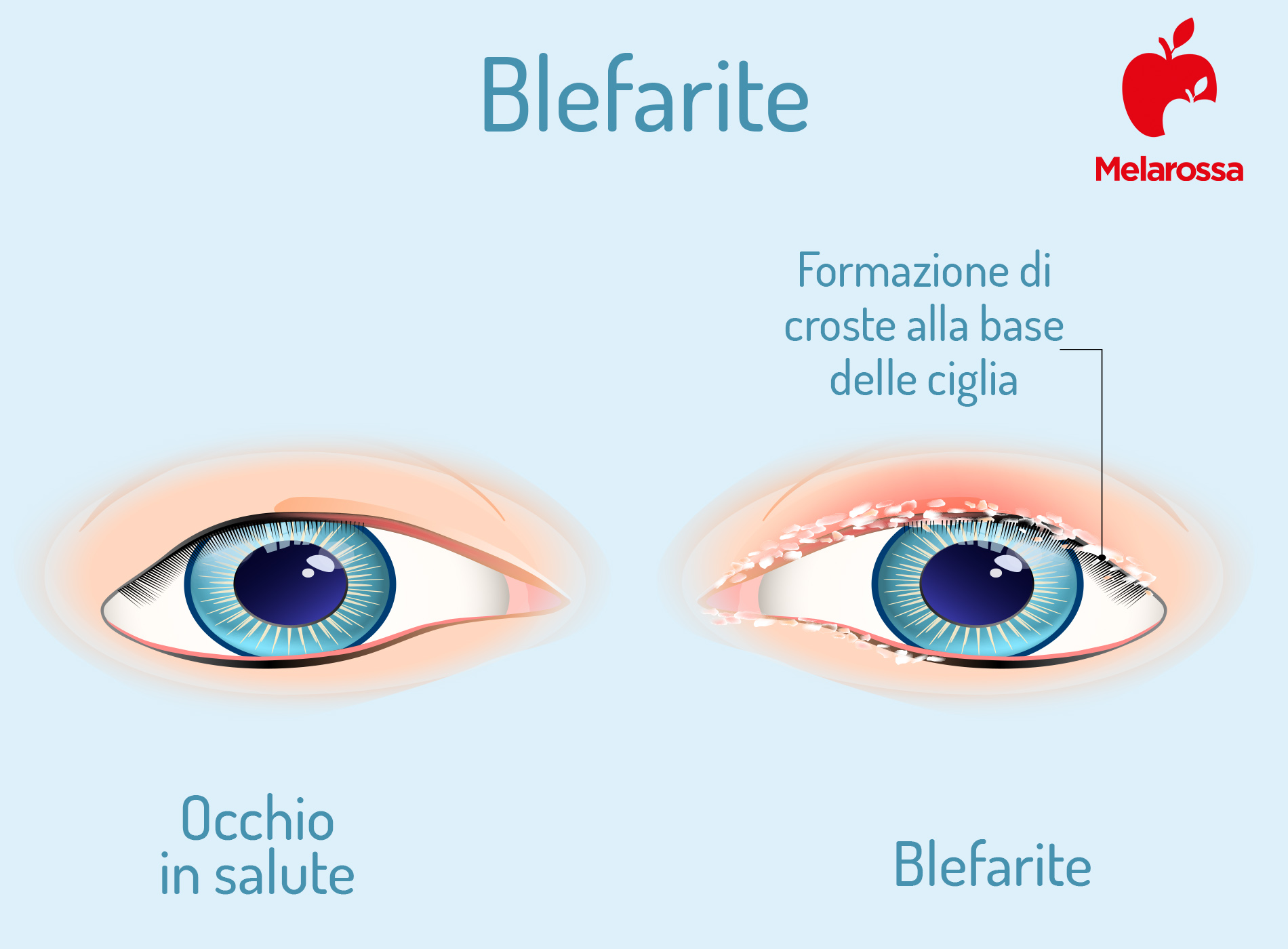 Blefarite: cos’è, tipi, cause, sintomi, diagnosi, cure e trattamento, prevenzione 1 blefarite: che cos'è