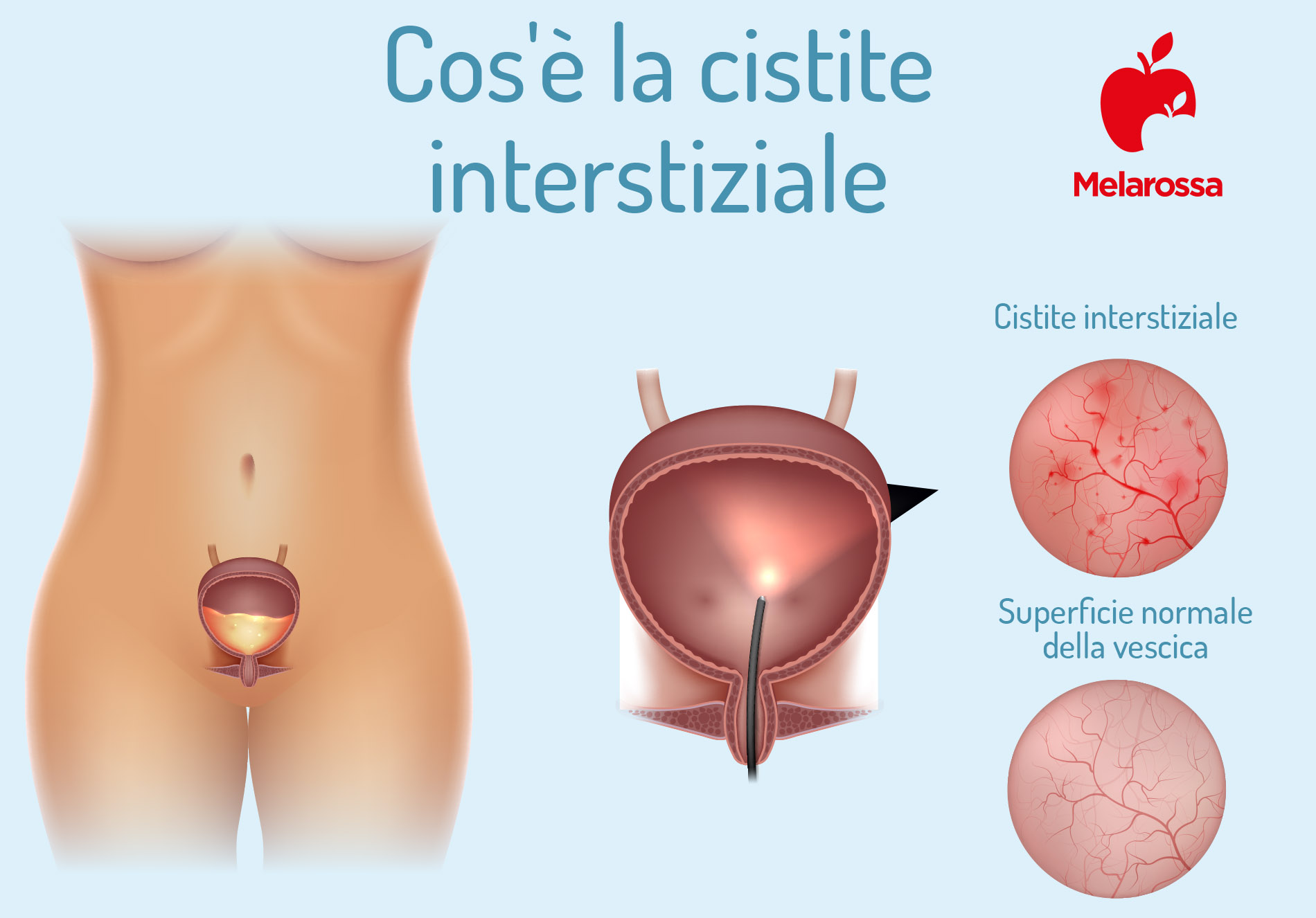 Cistite interstiziale: cos’è, sintomi, cause, cure e decorso 1 cistite intersiziale: che cos'è