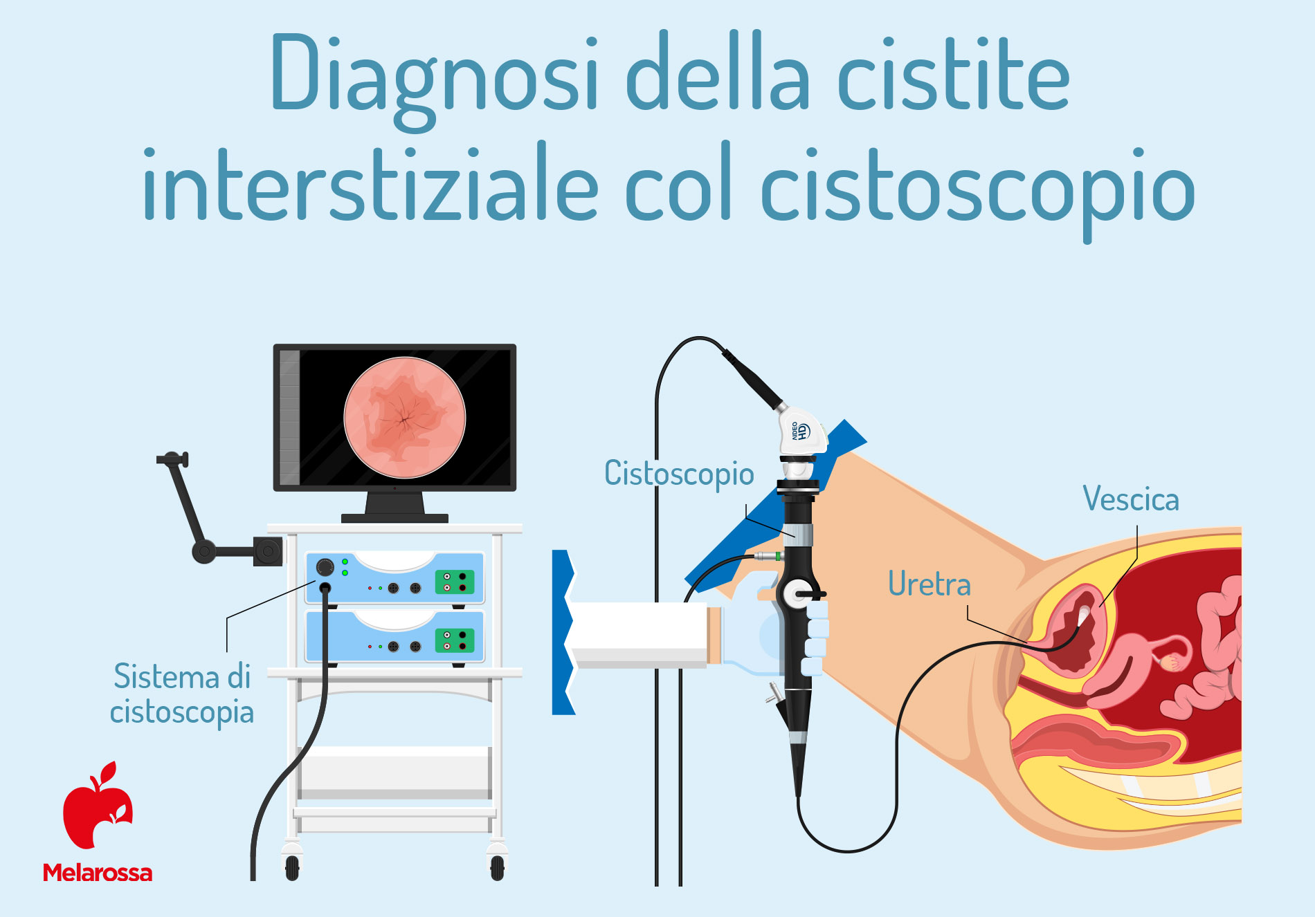 Cistite interstiziale: cos’è, sintomi, cause, cure e decorso 5 cistite interstiziale: cistoscopio