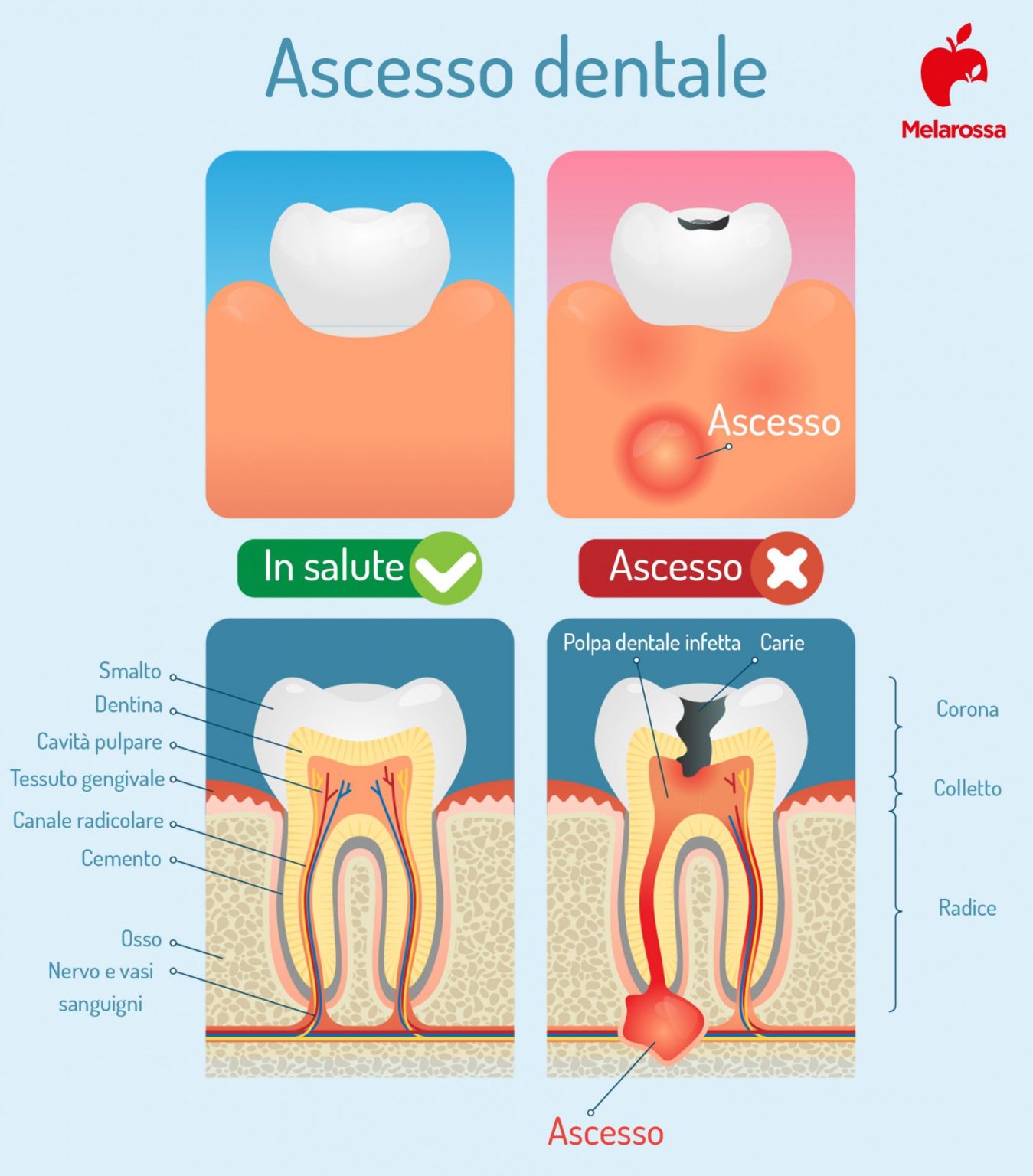 Denti: quali sono, a cosa servono, come sono fatti, principali patologie, sintomi e trattamenti 10 denti: foto dell'ascesso dentale
