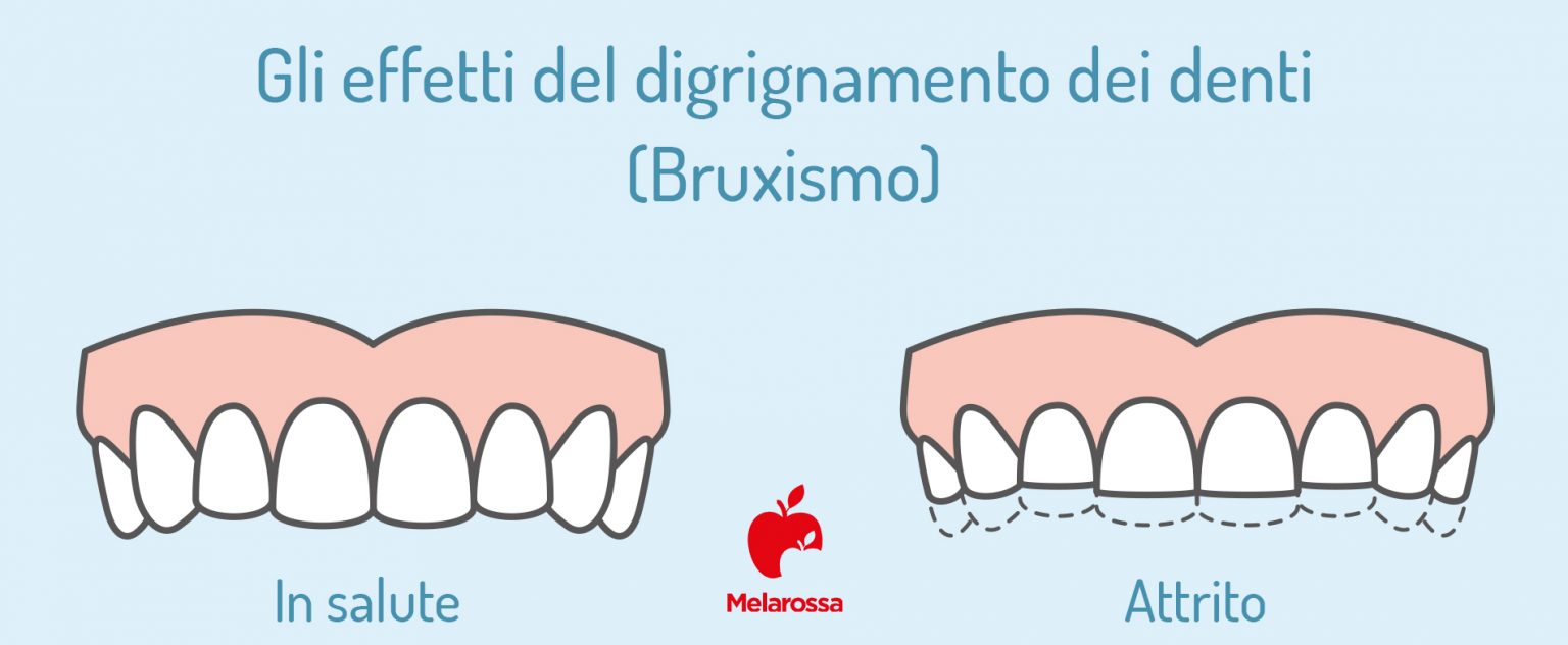 Denti: quali sono, a cosa servono, come sono fatti, principali patologie, sintomi e trattamenti 5 denti-bruxismo-infografica