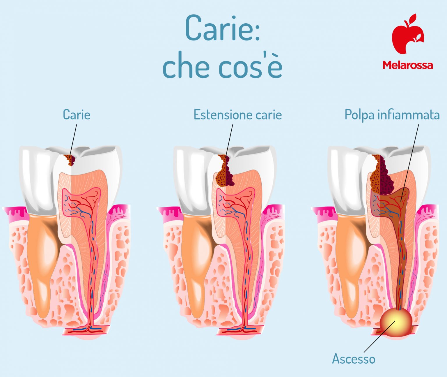Denti: quali sono, a cosa servono, come sono fatti, principali patologie, sintomi e trattamenti 4 denti: carie