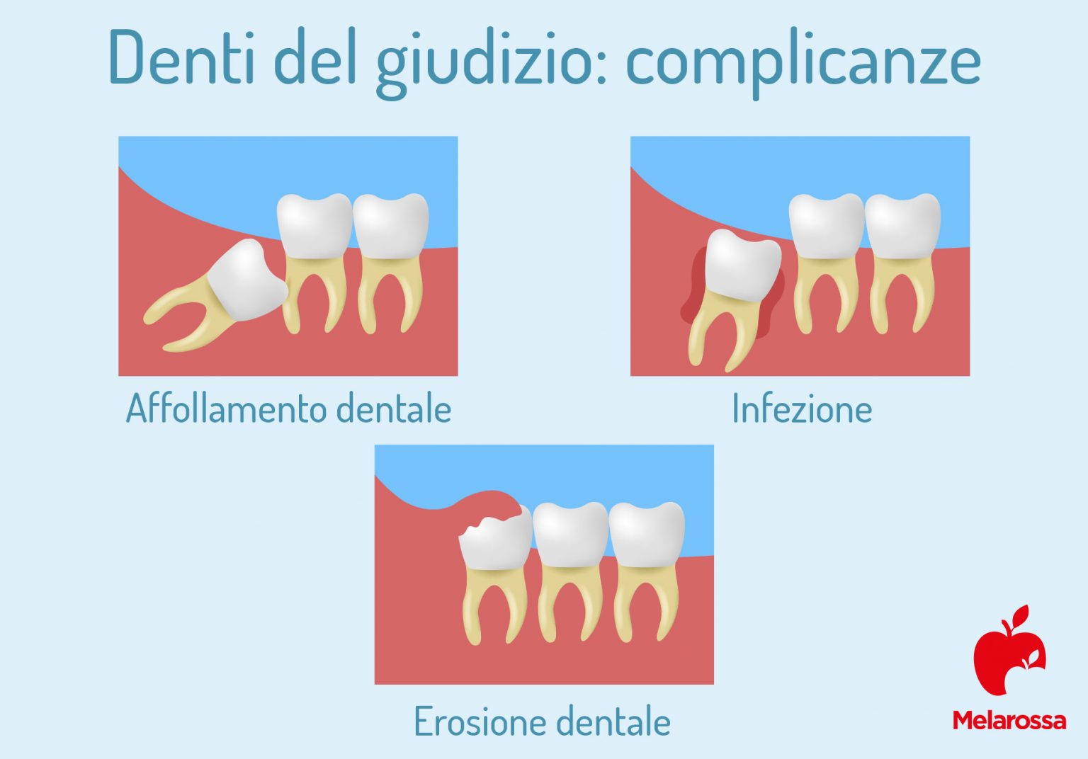 Denti: quali sono, a cosa servono, come sono fatti, principali patologie, sintomi e trattamenti 6 denti del giudizio