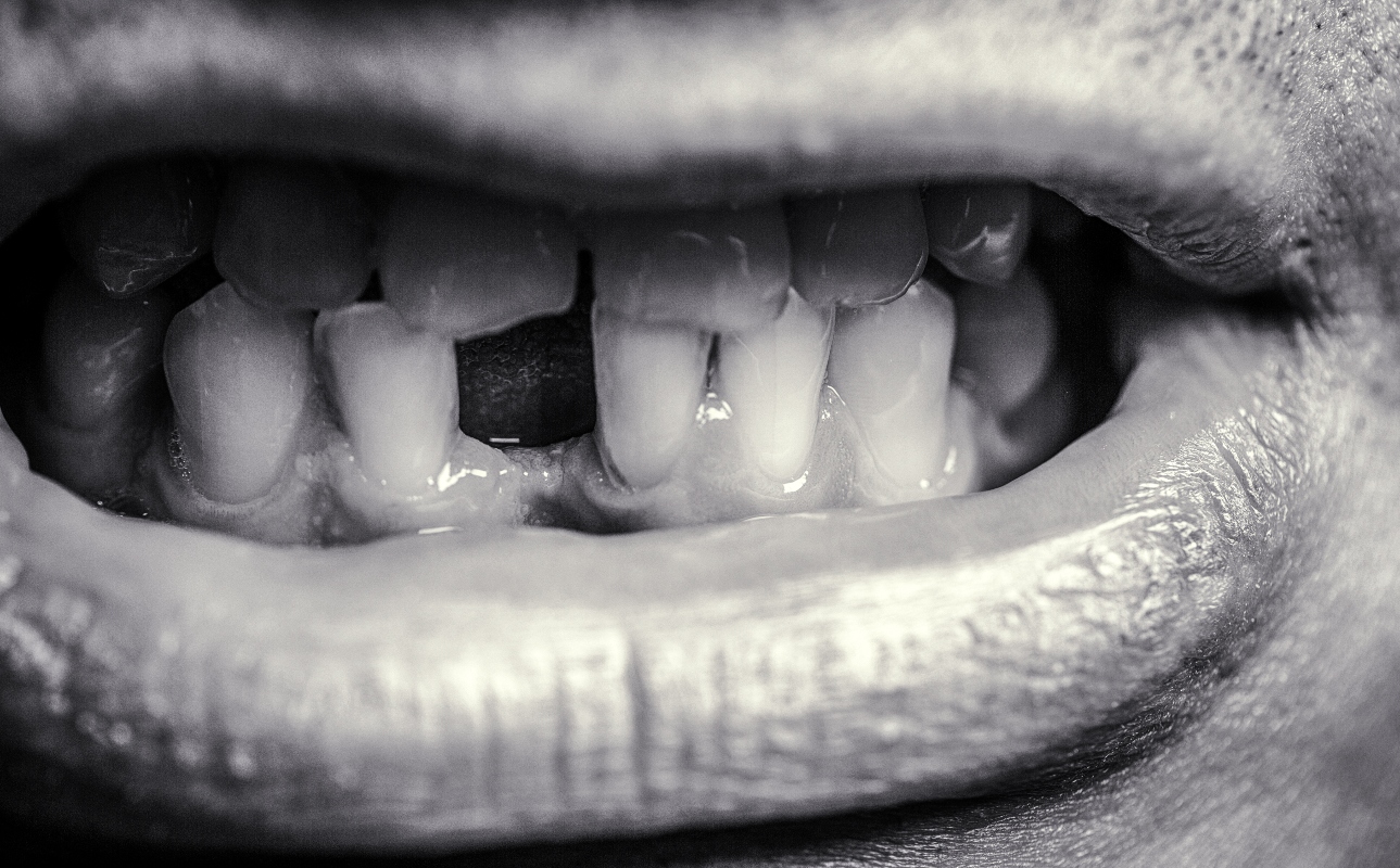 Denti: quali sono, a cosa servono, come sono fatti, principali patologie, sintomi e trattamenti 3 denti: malattie e infezioni dentali