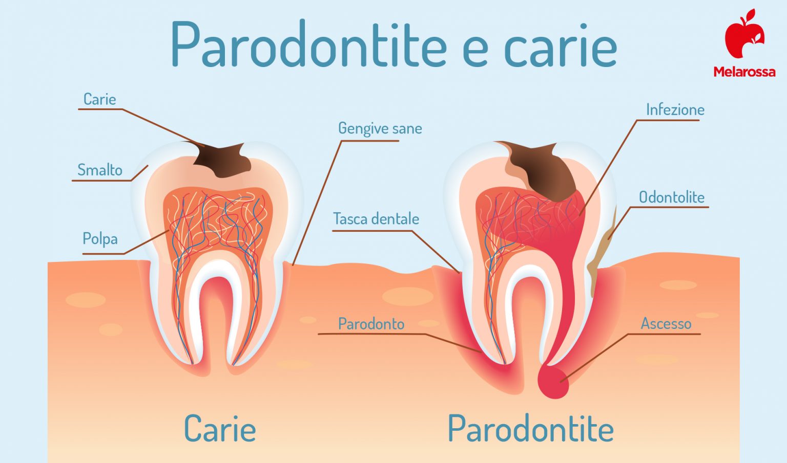 Denti: quali sono, a cosa servono, come sono fatti, principali patologie, sintomi e trattamenti 7 denti: paradontite