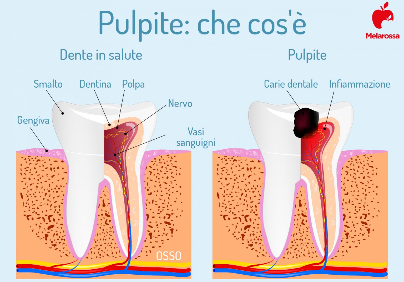Denti: quali sono, a cosa servono, come sono fatti, principali patologie, sintomi e trattamenti 9 denti pulpite