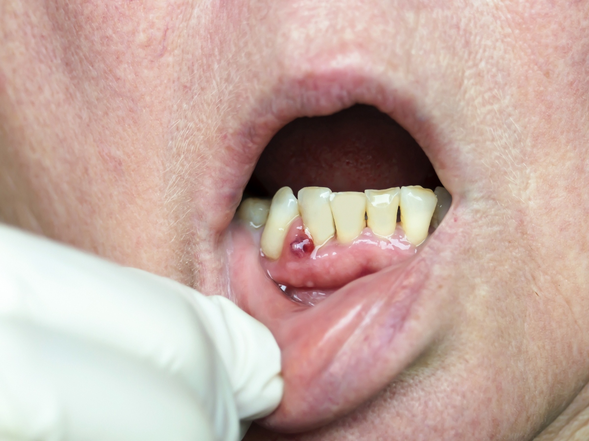 Granuloma dentale: cos’è, cause, sintomi, complicanze e come curare l’infezione 2 granuloma dentale: come si cura